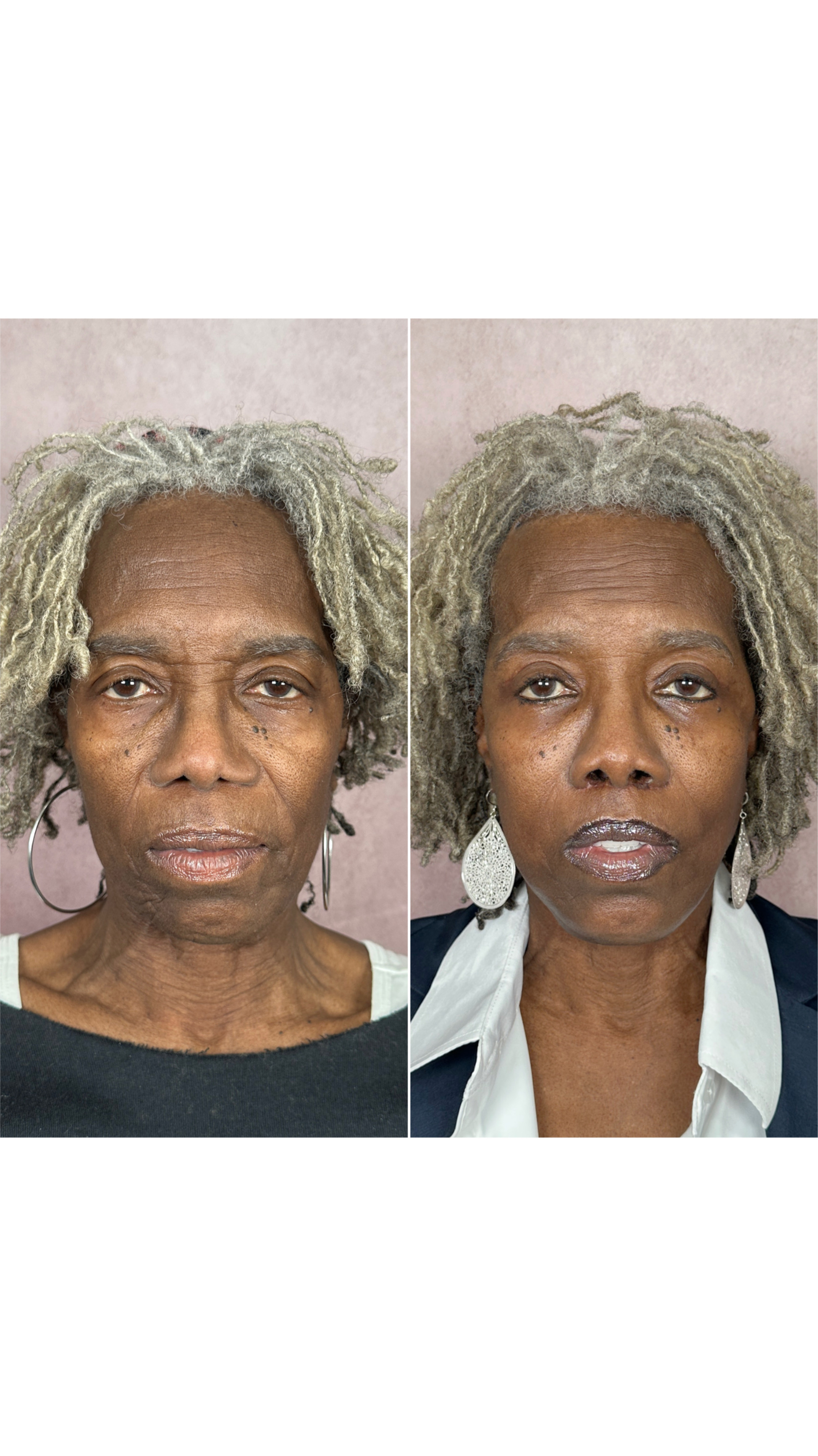 Alarplasty before and after &mdash; featured patient · before and after composite
