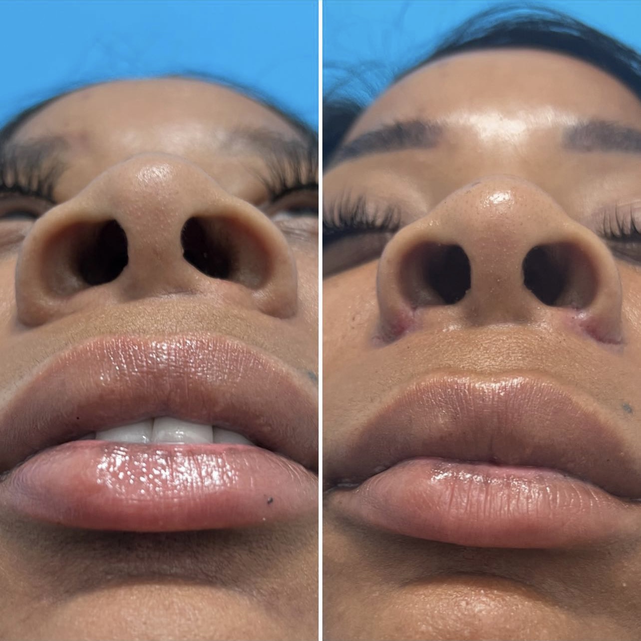 Before and after &mdash; alarplasty, nostril refinement · before and after composite