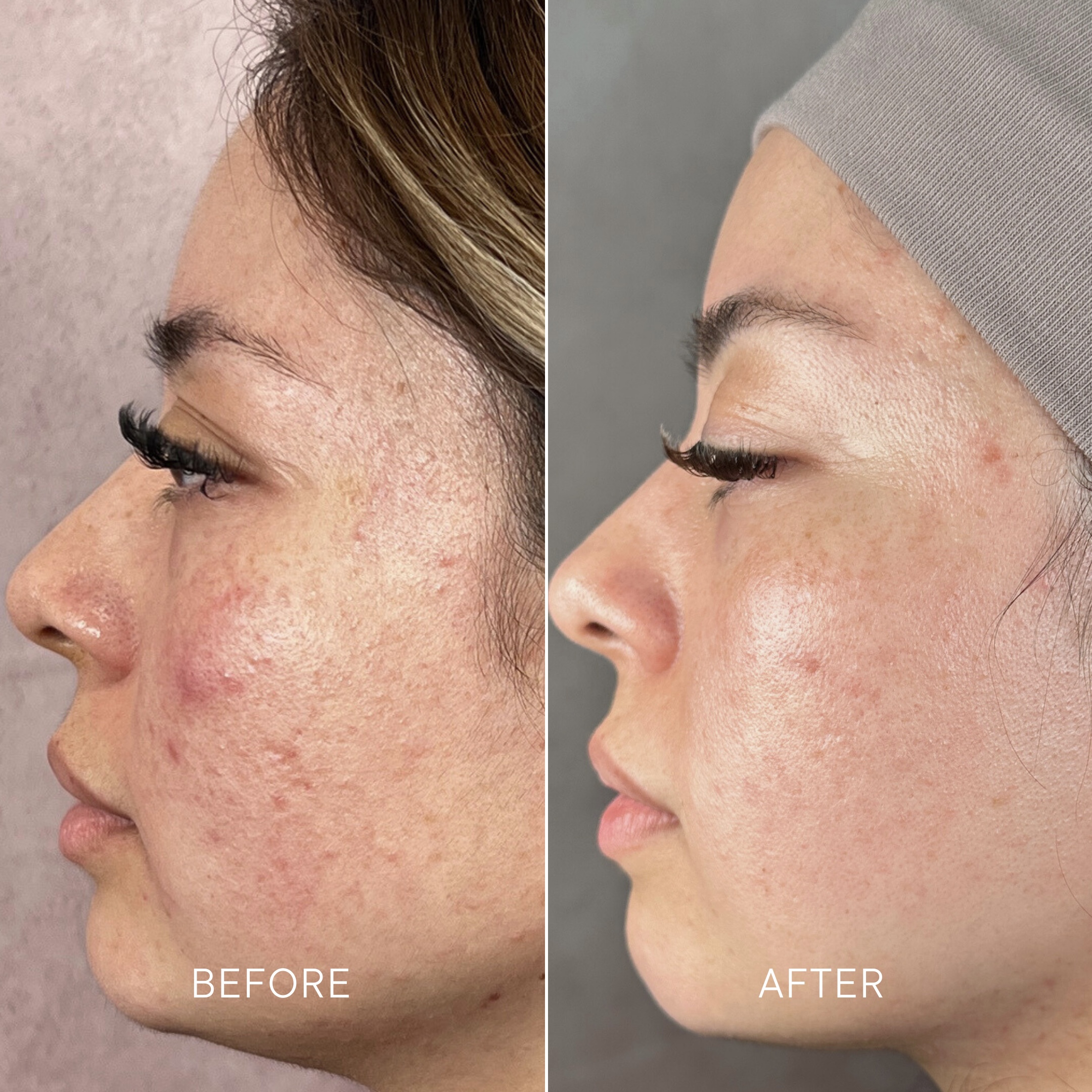 Artisa skincare before and after · before and after composite