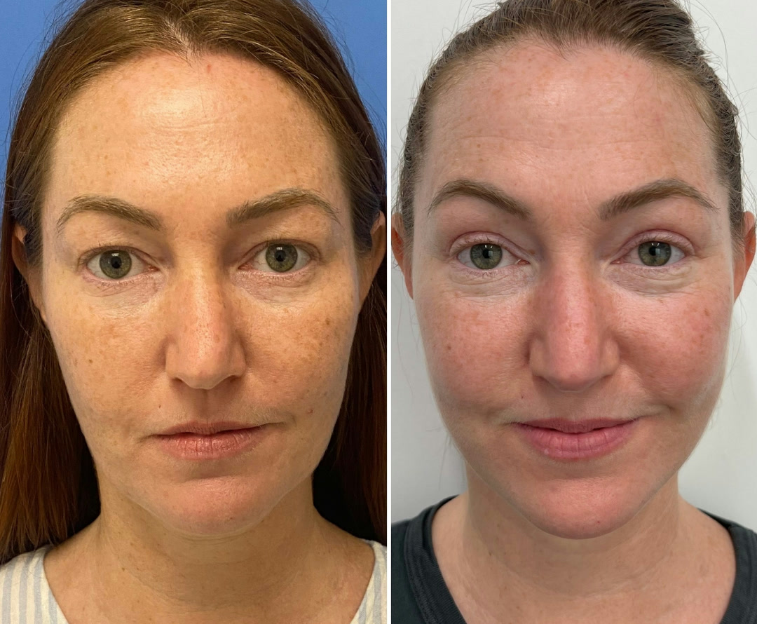 Upper Blepharoplasty + Face + Neck Lift &mdash; featured patient before and after · frontal view