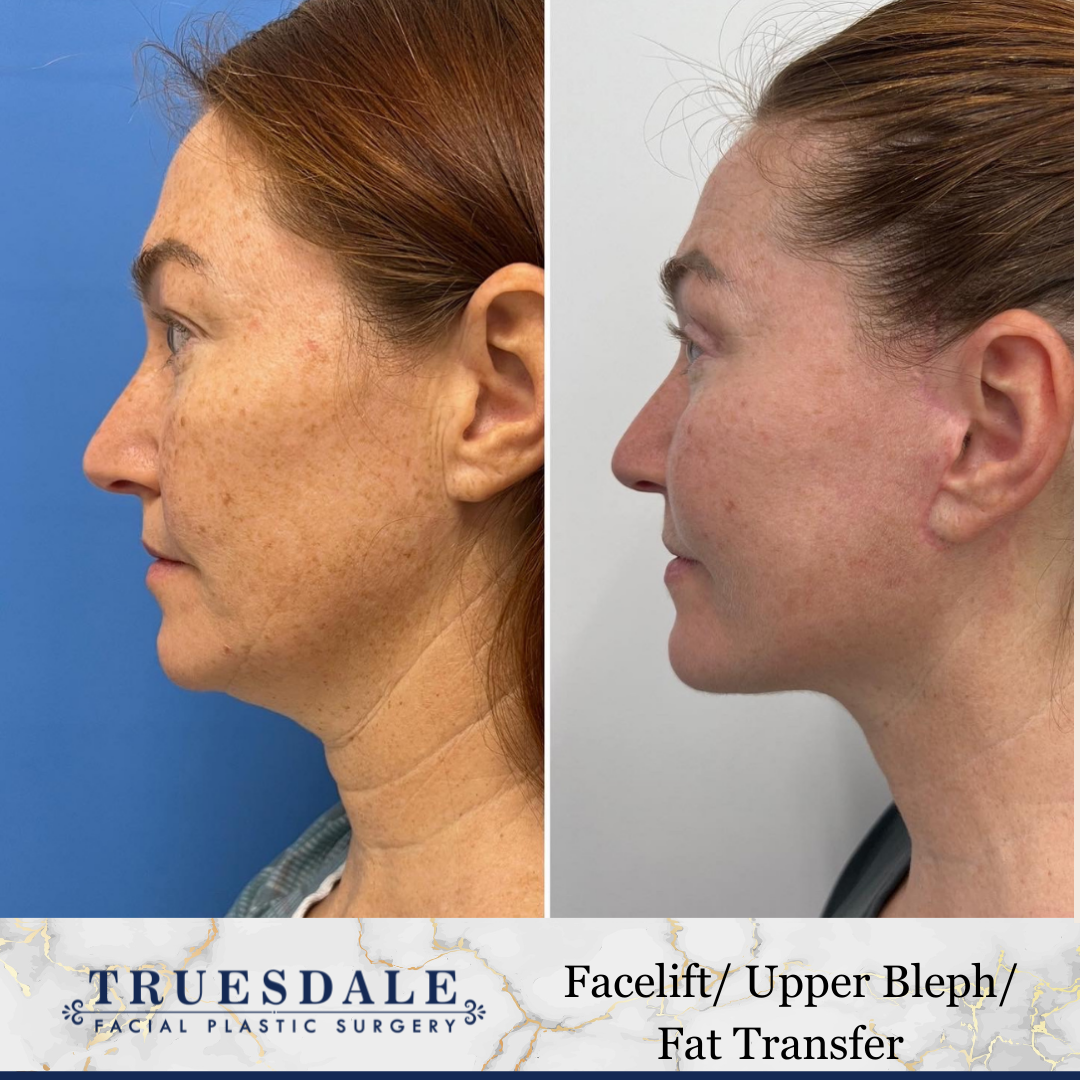 Before and after — facelift, upper bleph & fat transfer, profile