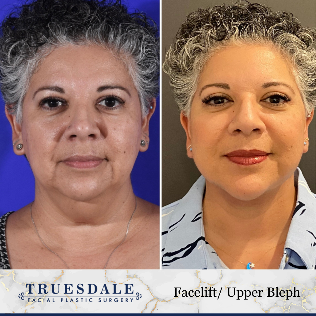 Before and after — facelift & upper blepharoplasty · before and after composite