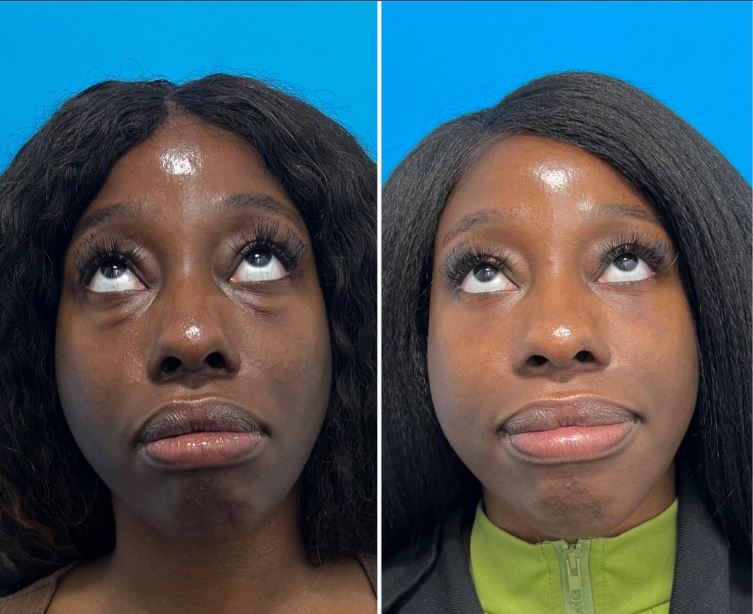 Lower blepharoplasty before and after · frontal view