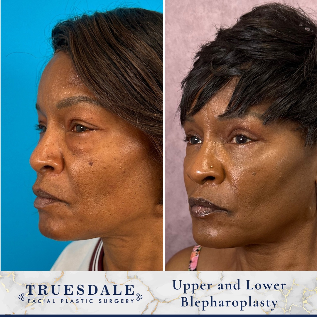 Before and after — upper and lower blepharoplasty, oblique view