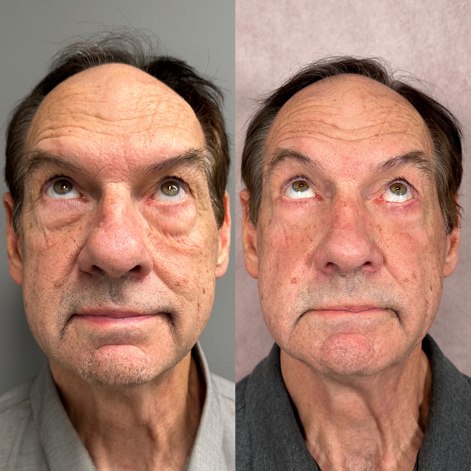 Lower blepharoplasty before and after &mdash; featured patient · frontal view