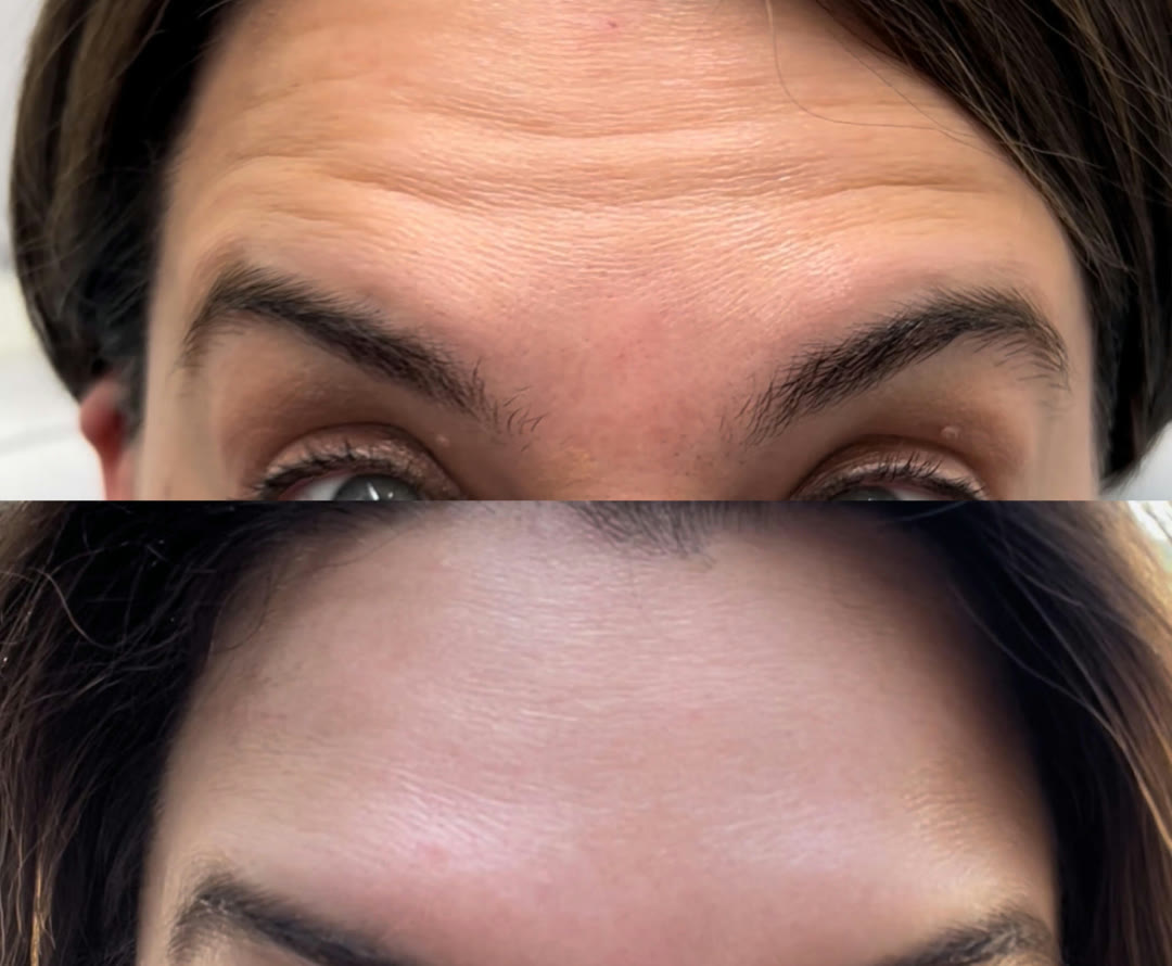 Botox before and after &mdash; smoothed forehead lines · before and after composite