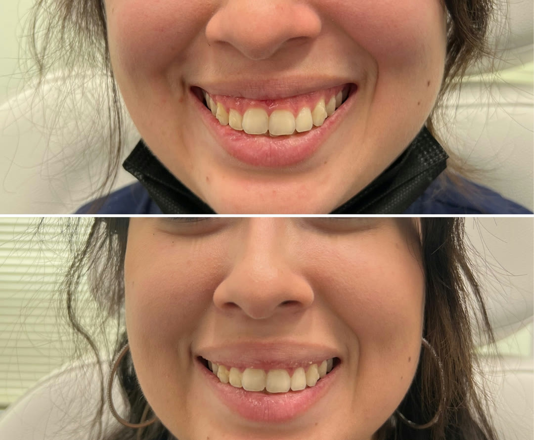 Botox for gummy smile before and after &mdash; softened upper-lip elevation · before and after composite