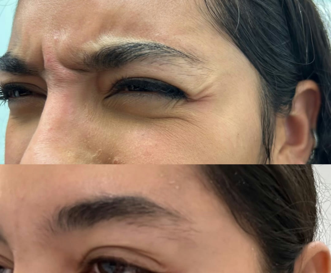 Before and after &mdash; Daxxify &mdash; Crow&rsquo;s Feet · before and after composite