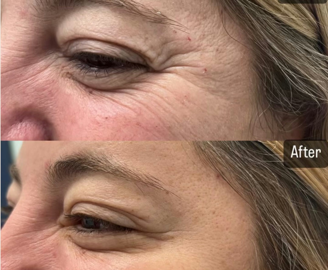 Before and after &mdash; Daxxify &mdash; Crow&rsquo;s Feet · before and after composite