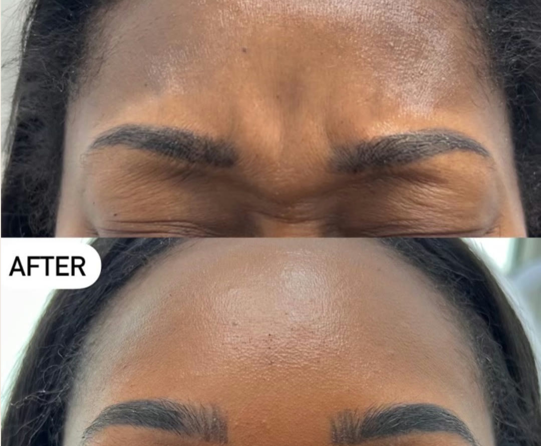 Daxxify before and after &mdash; smoothed glabellar (11s) lines · before and after composite