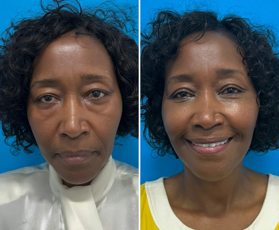 Brow lift as part of The Masterpiece — deep plane facelift, neck lift, brow lift, upper and lower blepharoplasty before and after · before and after composite