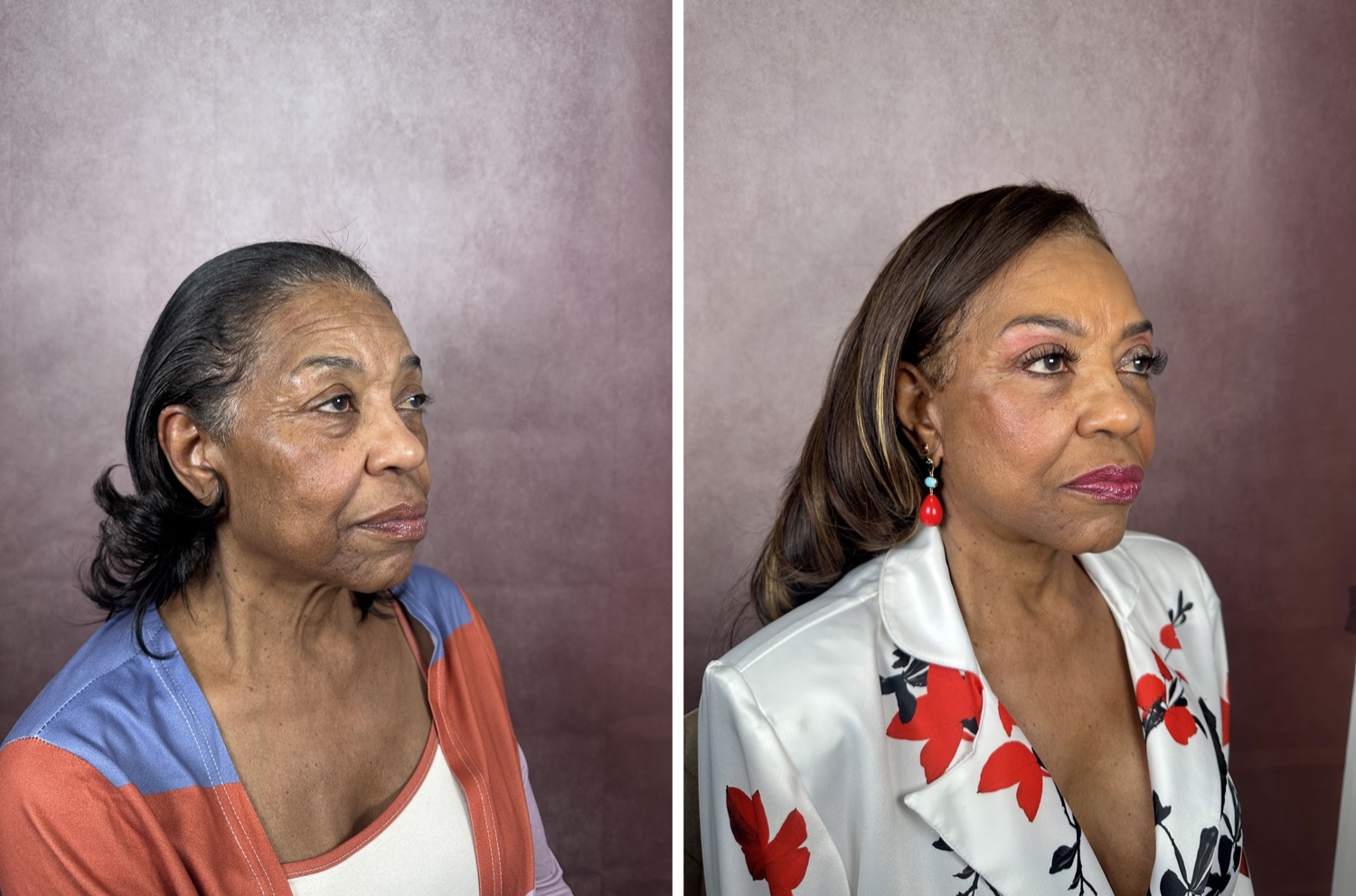 Before and after &mdash; brow lift with facelift, neck lift, and lower blepharoplasty, left oblique view