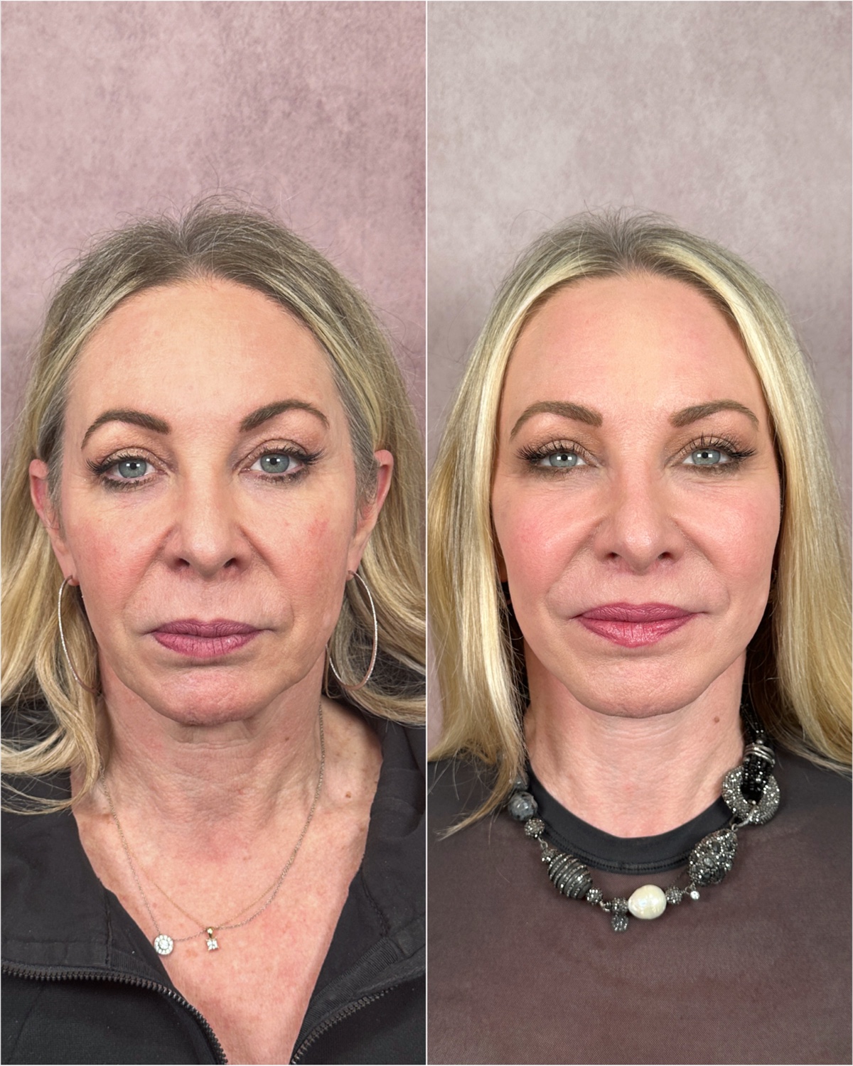 Brow lift before and after · oblique view