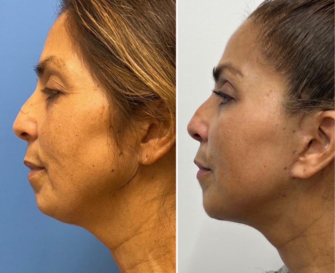 Chin implant + facelift before and after, profile view