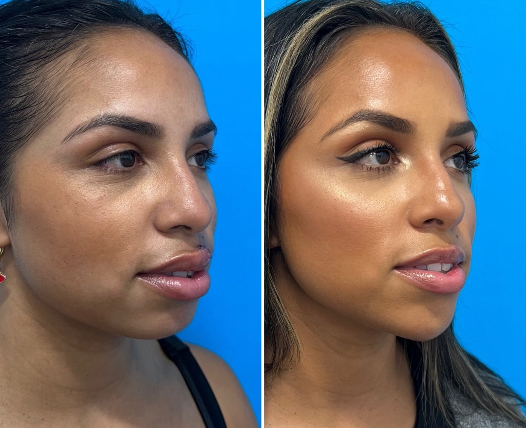 Chin implant before and after, frontal view