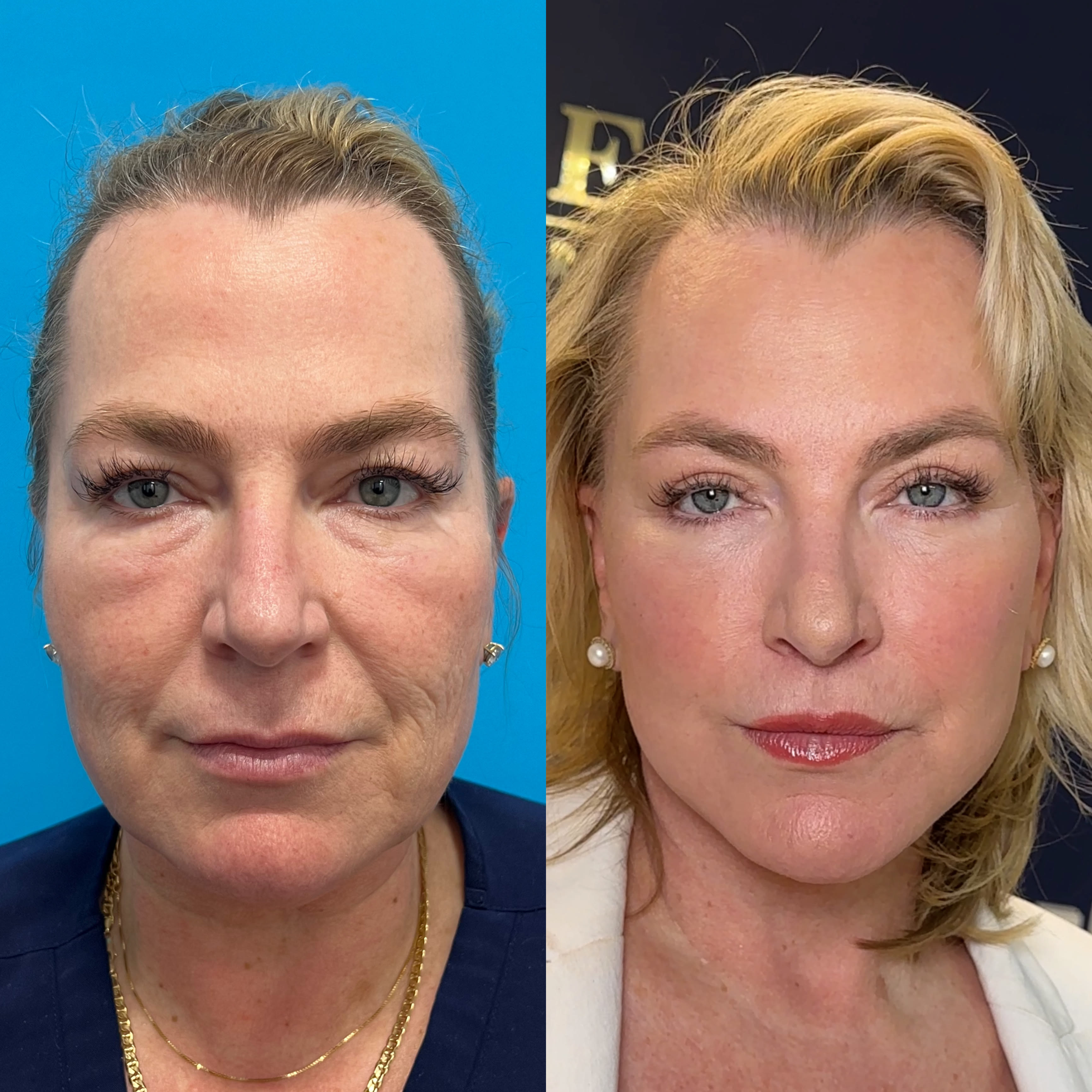CO2 laser combined with surgical procedures before and after · before and after composite