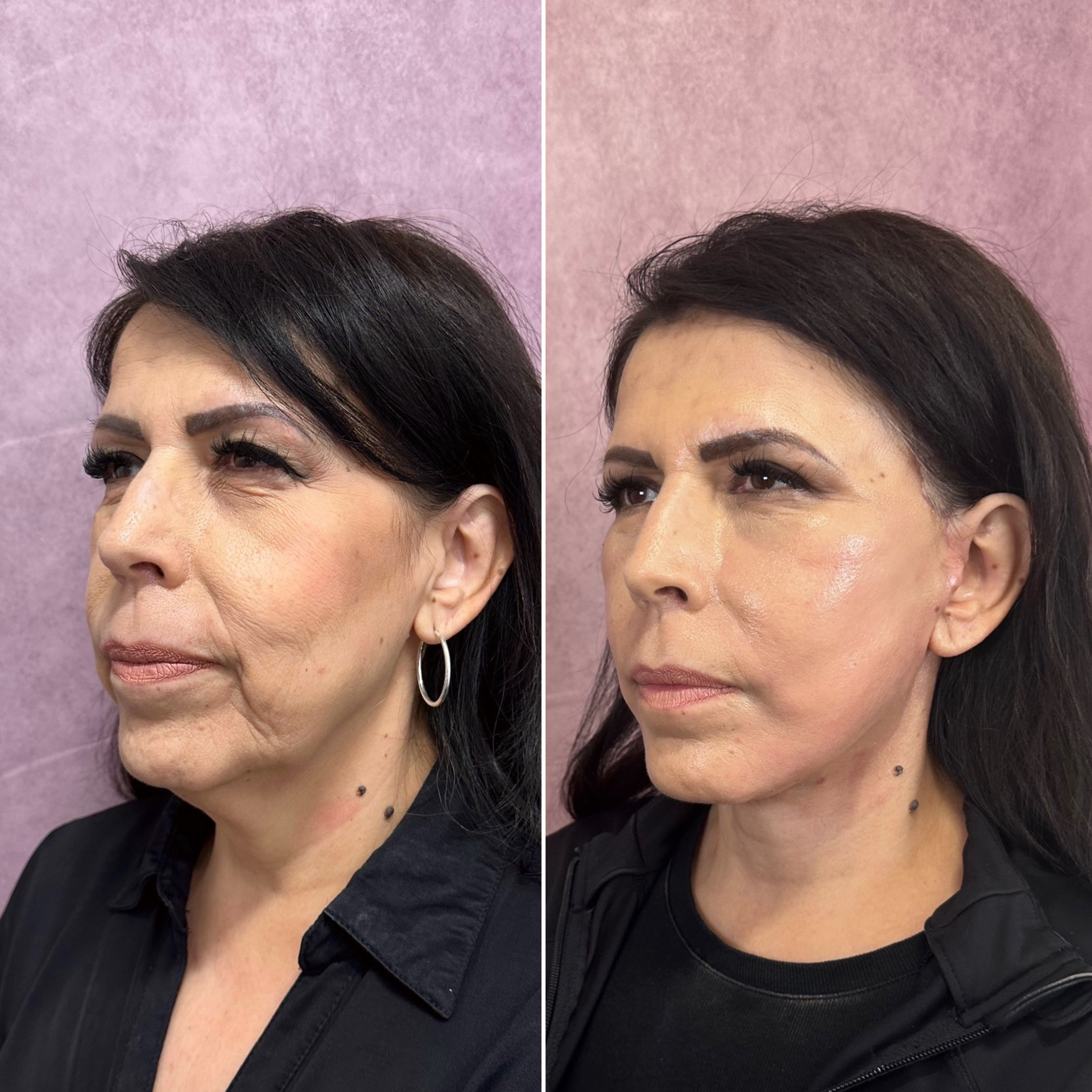 CO2 laser combined with surgical procedures before and after · before and after composite