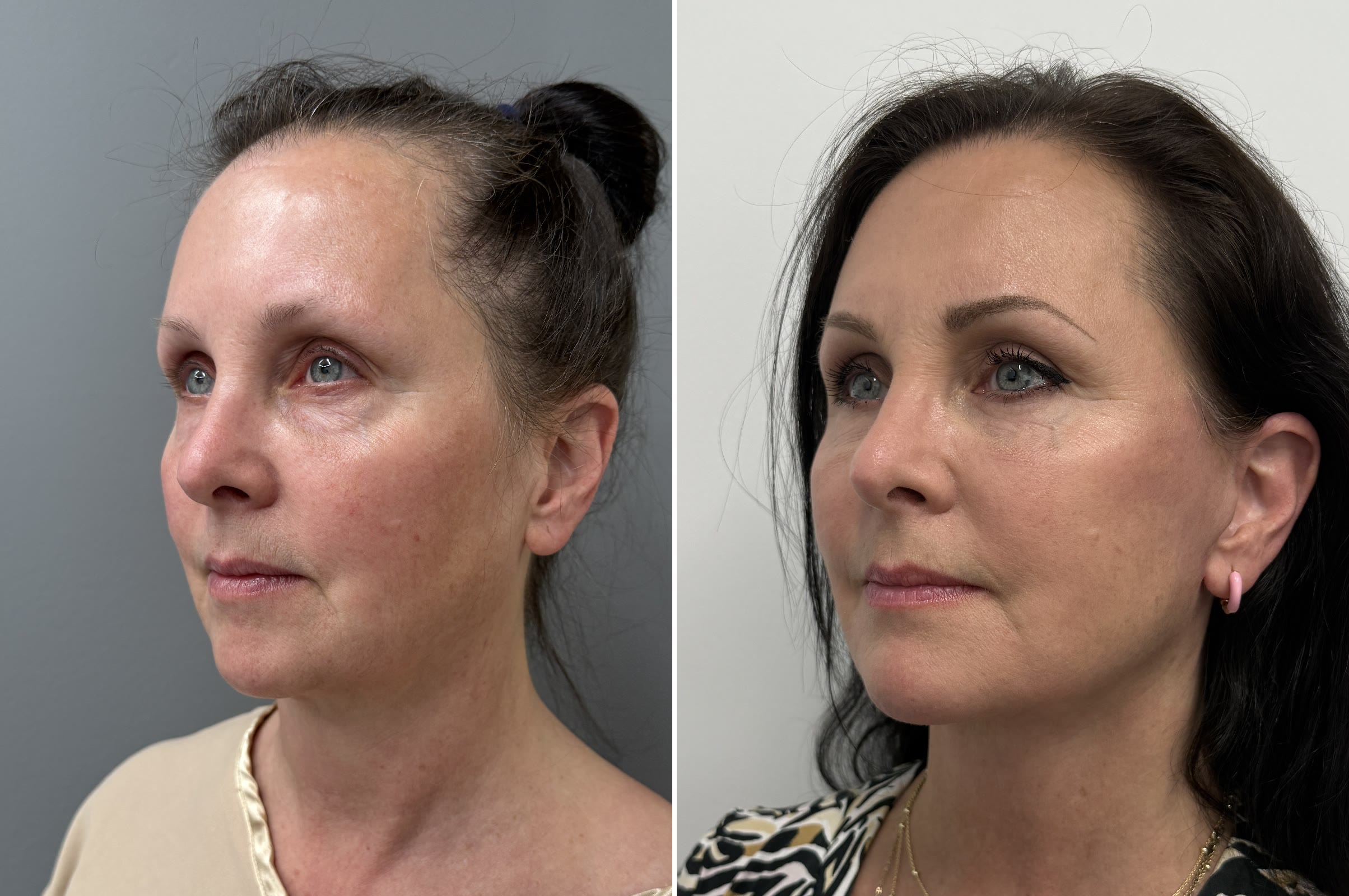 CO2 laser combined with surgical procedures before and after · before and after composite