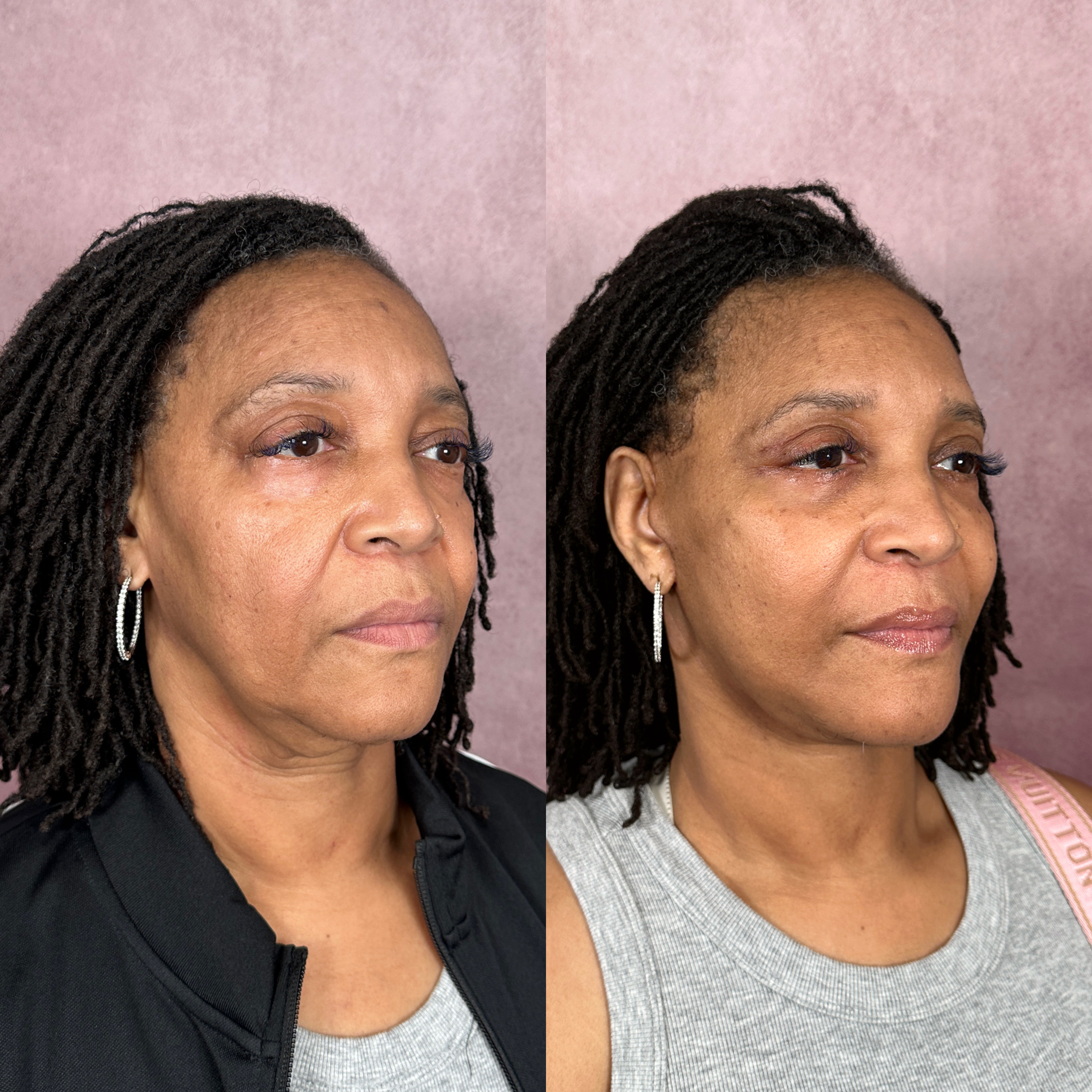 Before and after &mdash; The Masterpiece Surgery&trade;, oblique view