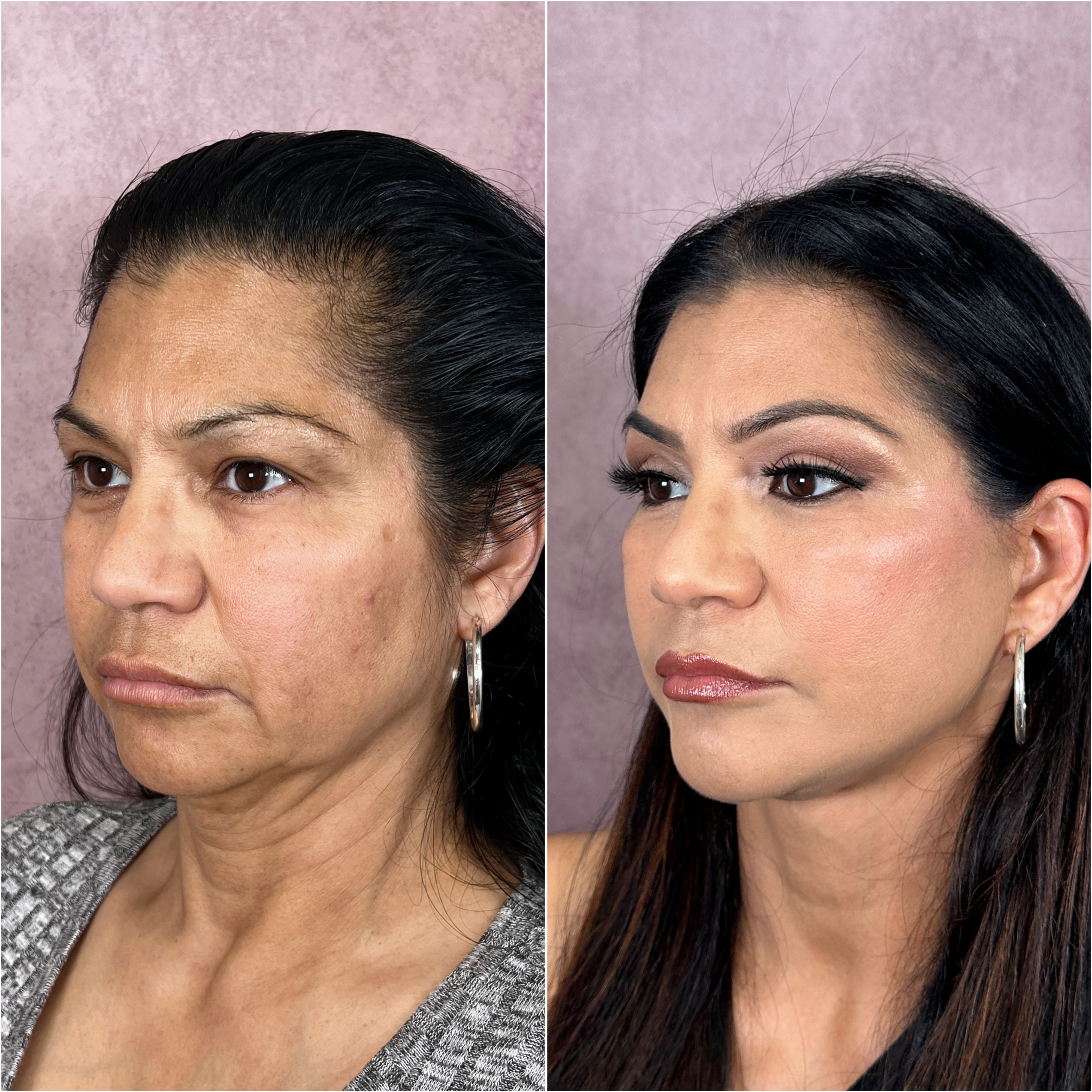 Before and after &mdash; facelift and neck lift, oblique view