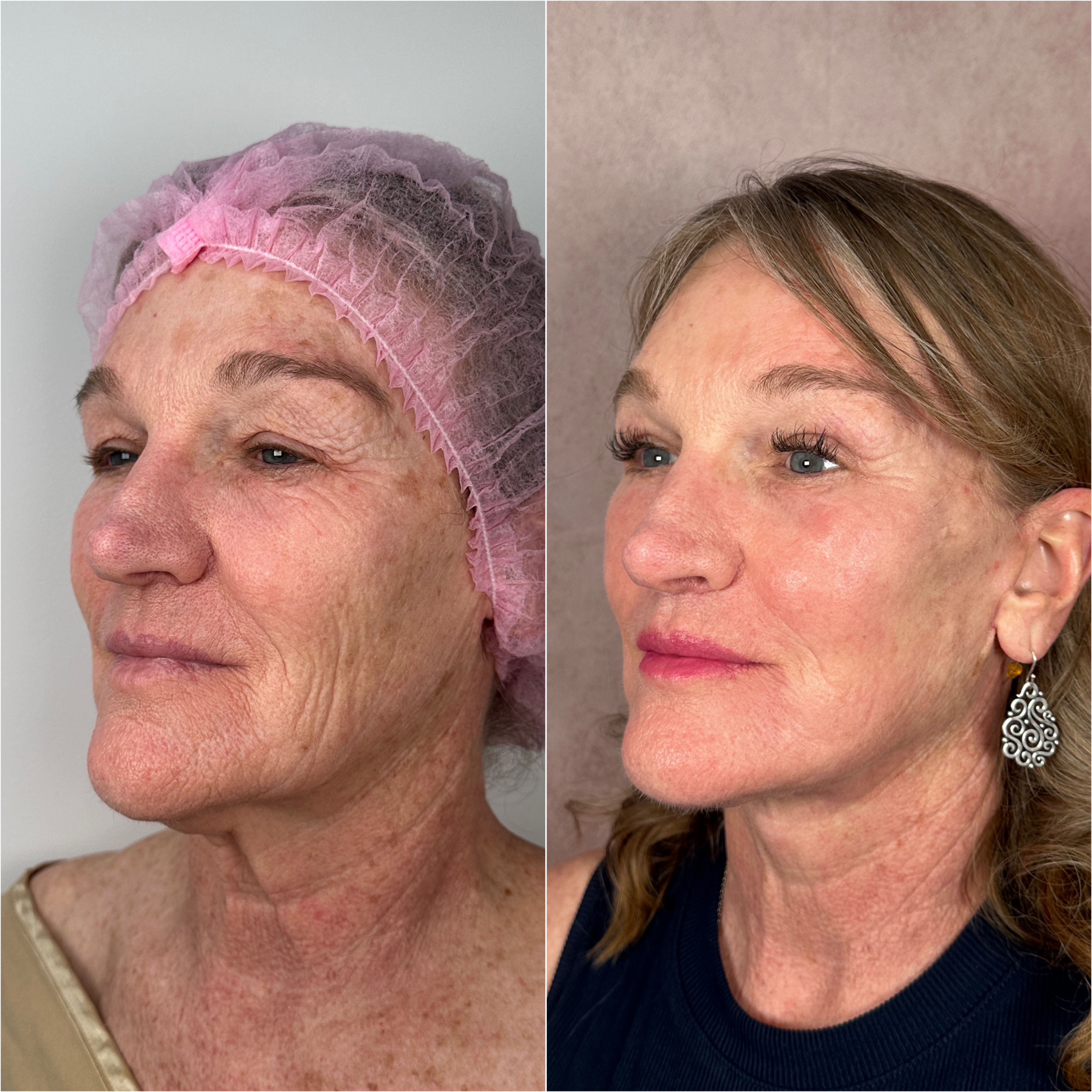 Before and after &mdash; facelift and neck lift, oblique view