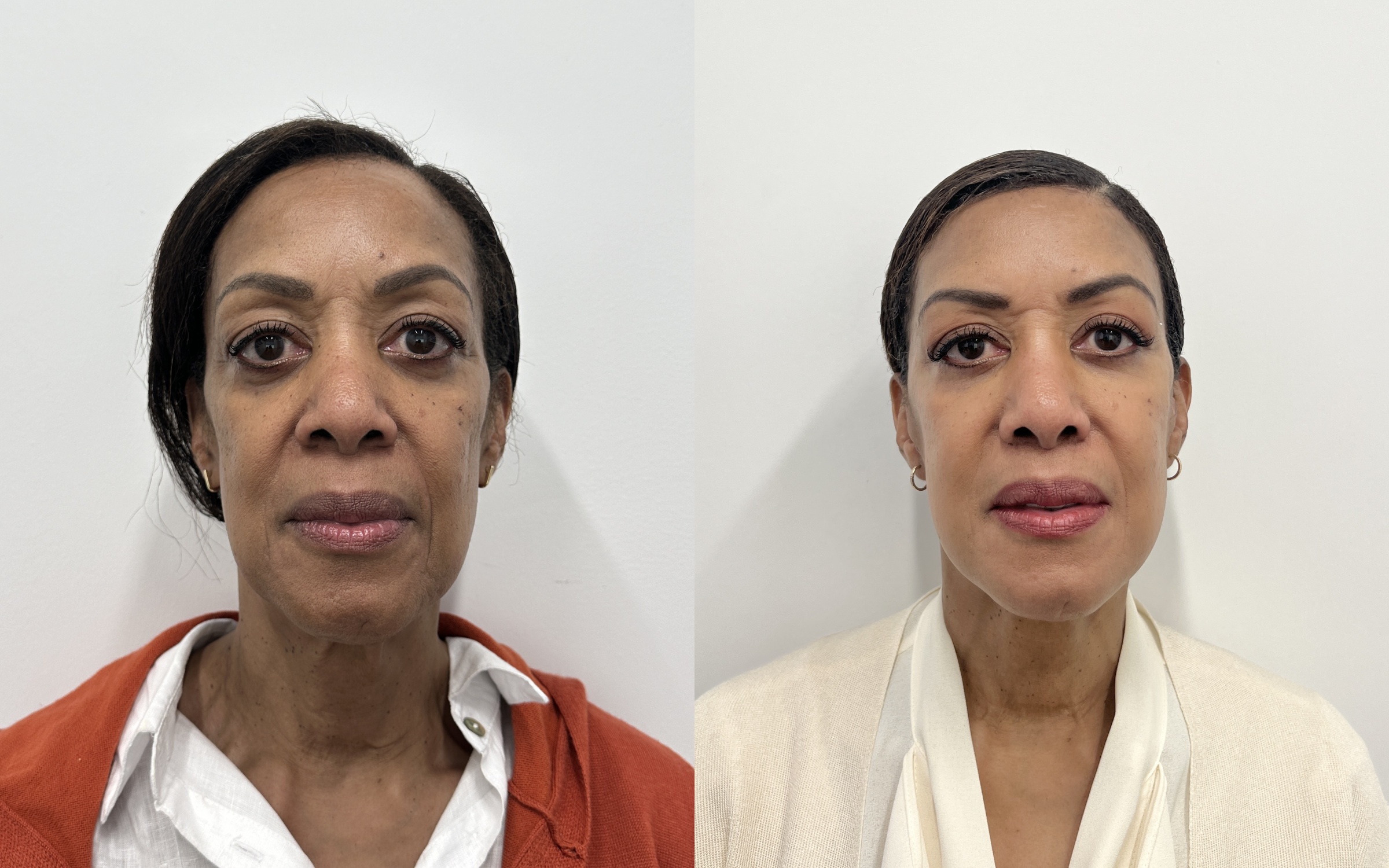 Before and after — deep plane facelift, frontal view