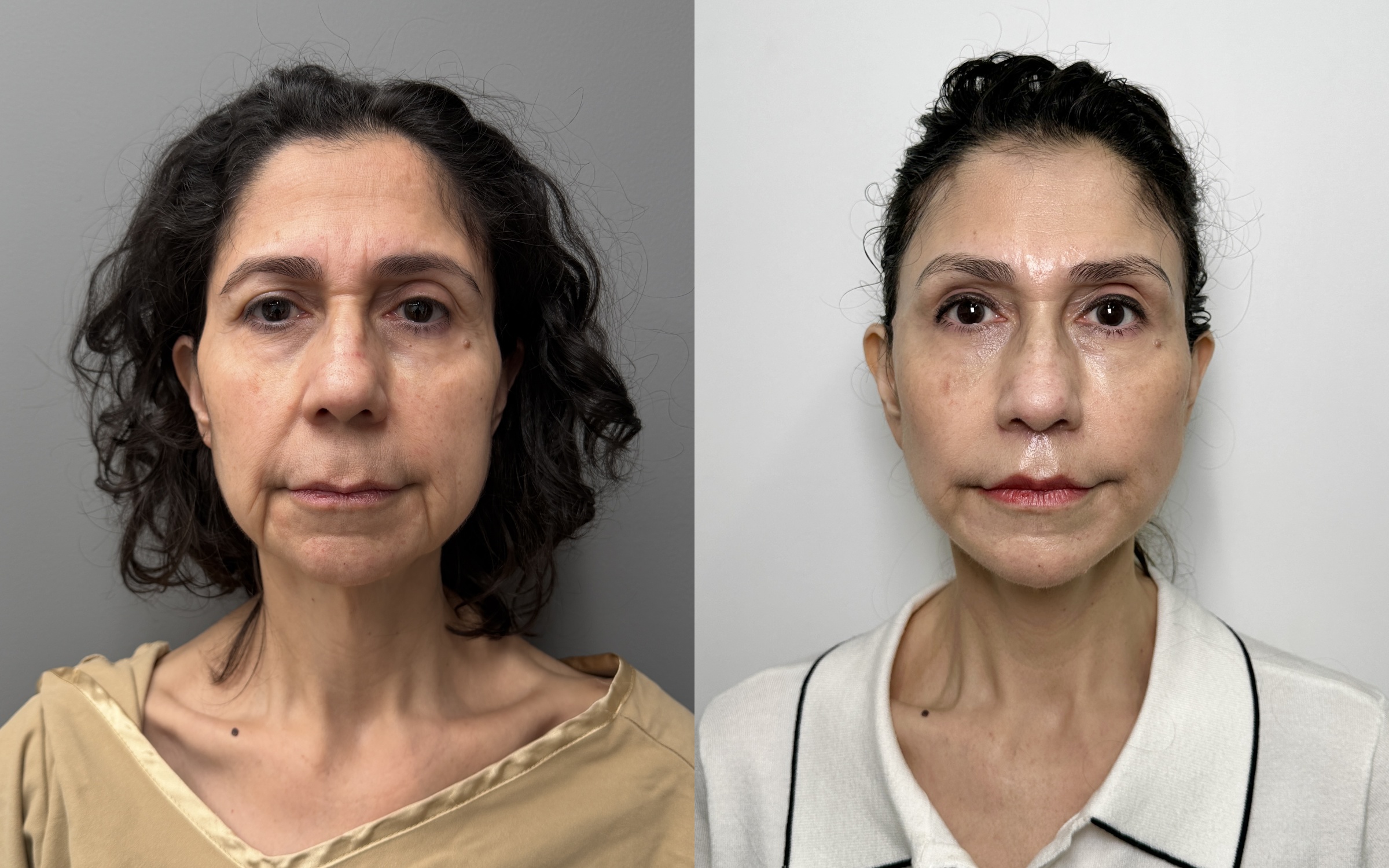 Before and after — deep plane facelift, frontal view