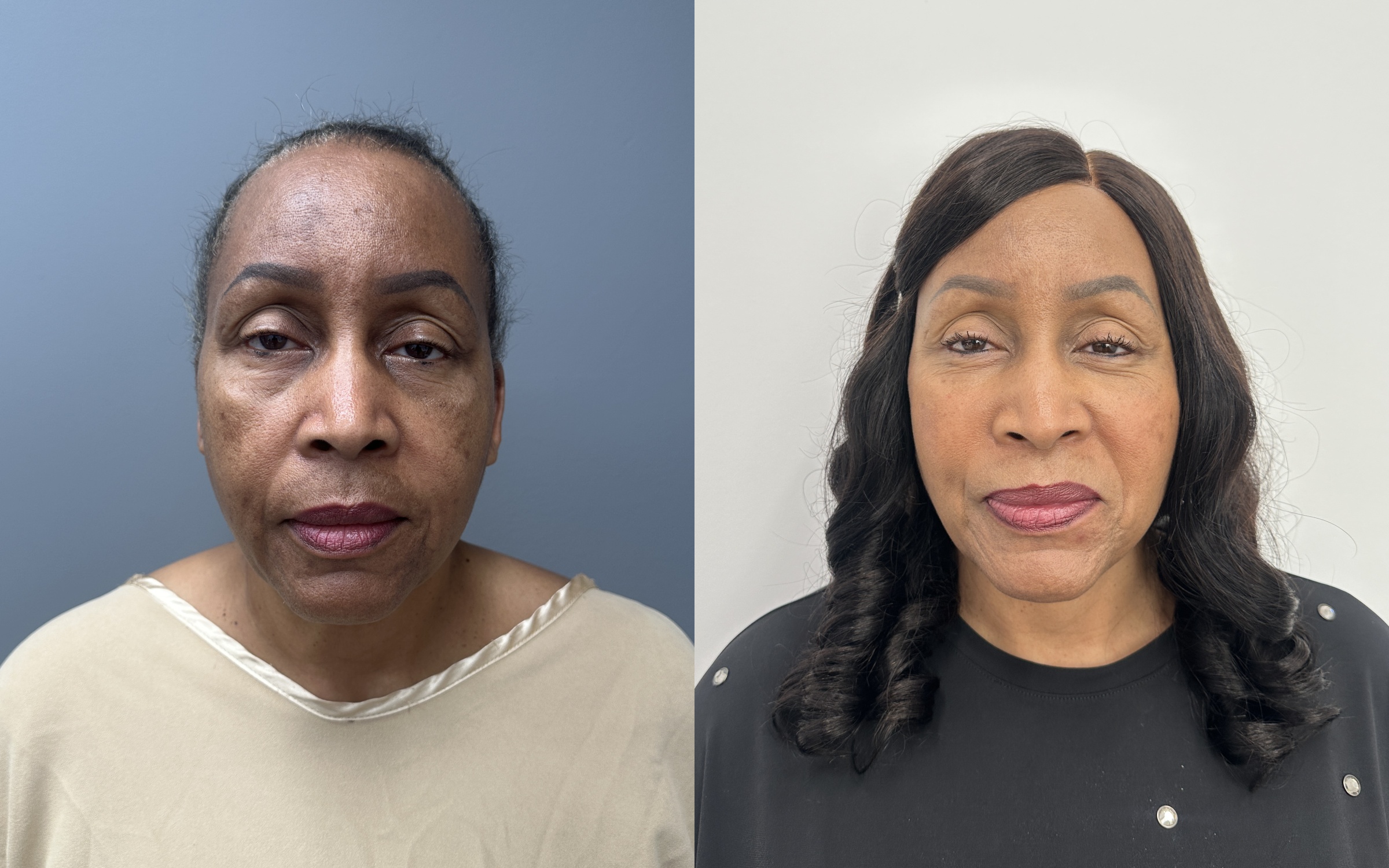 Before and after — deep plane facelift, frontal view