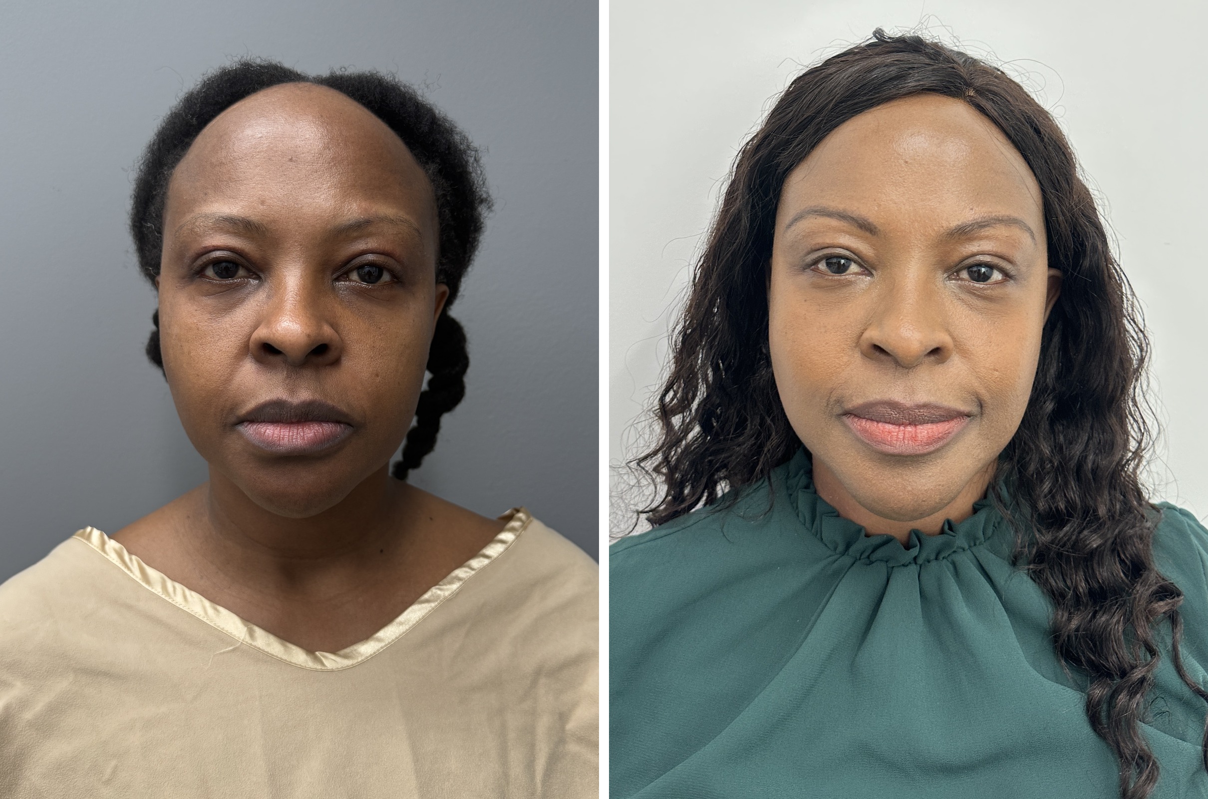 Before and after — deep plane facelift, frontal view