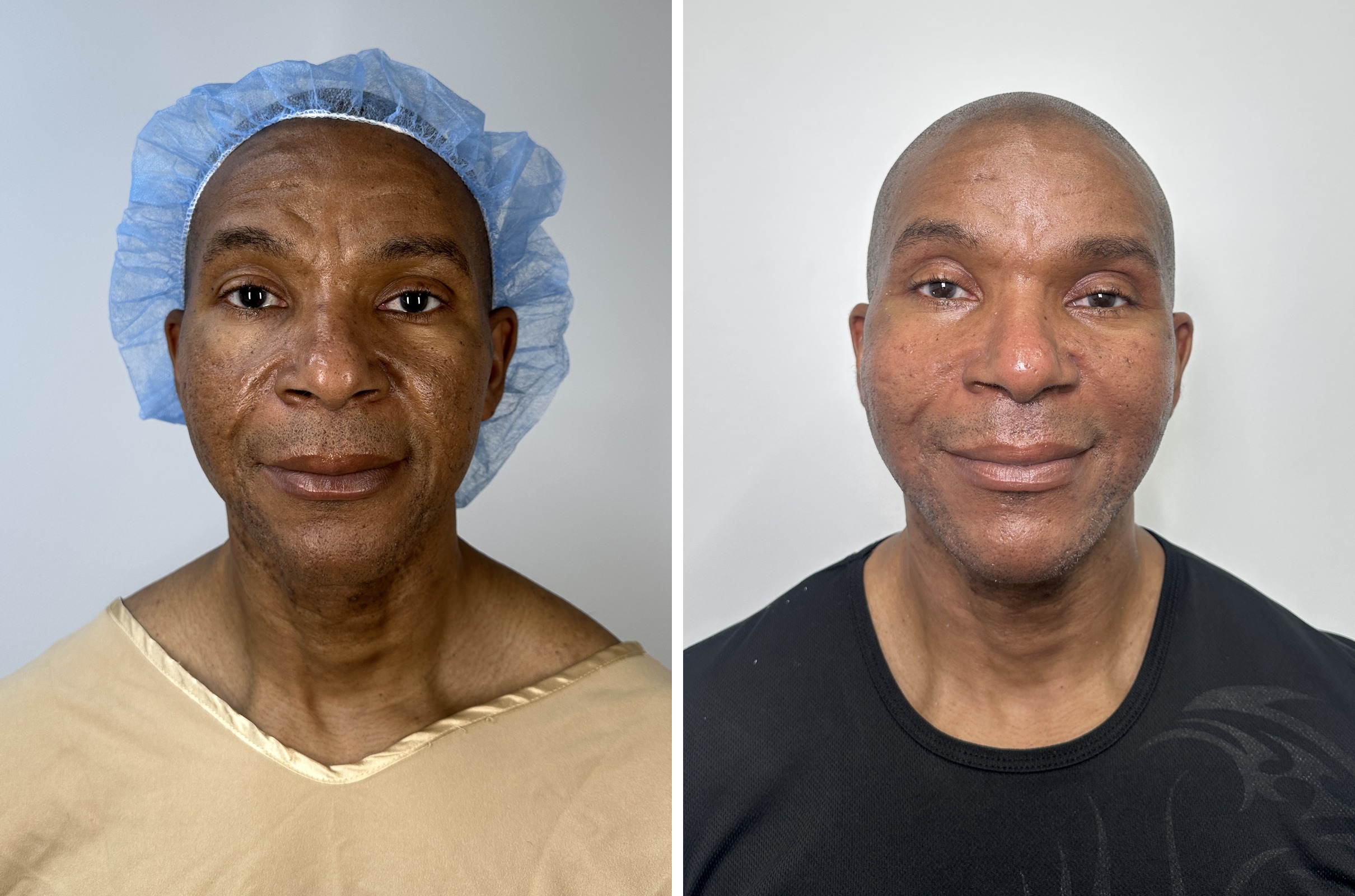 Before and after — male deep plane facelift, frontal view