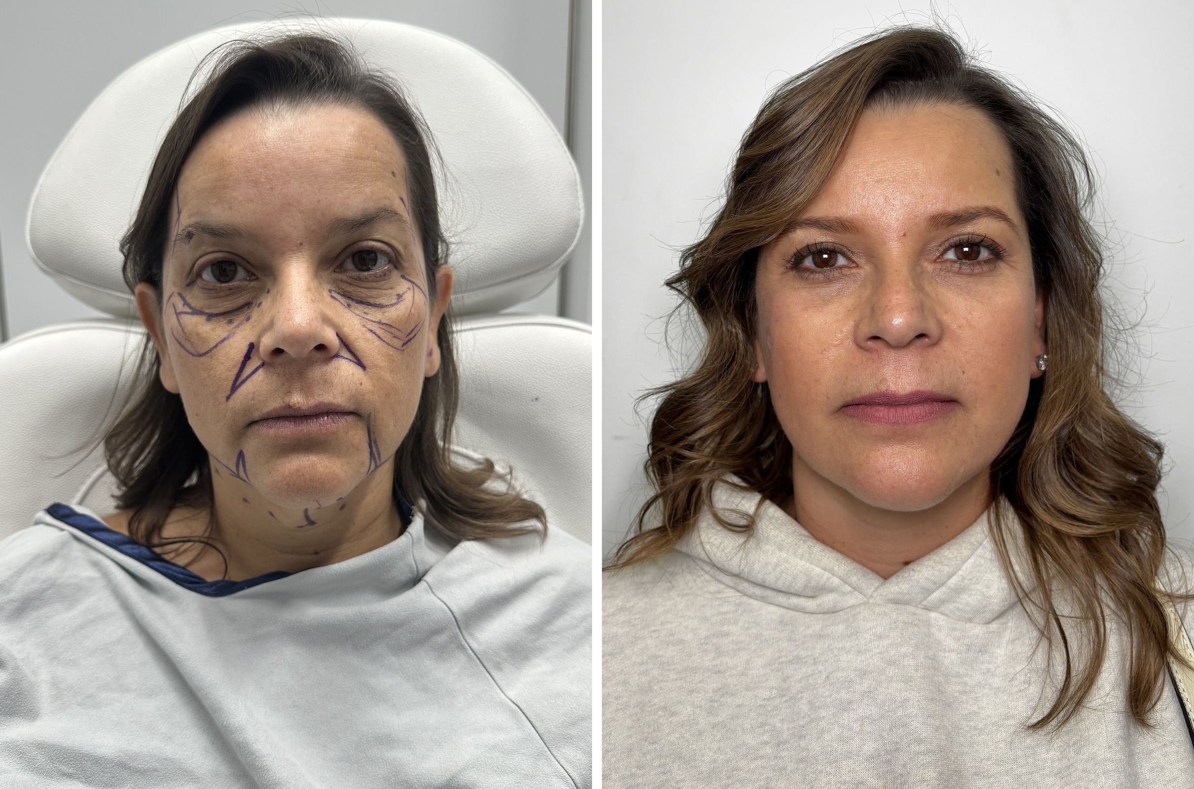 Before and after &mdash; deep plane facelift and neck lift, frontal view