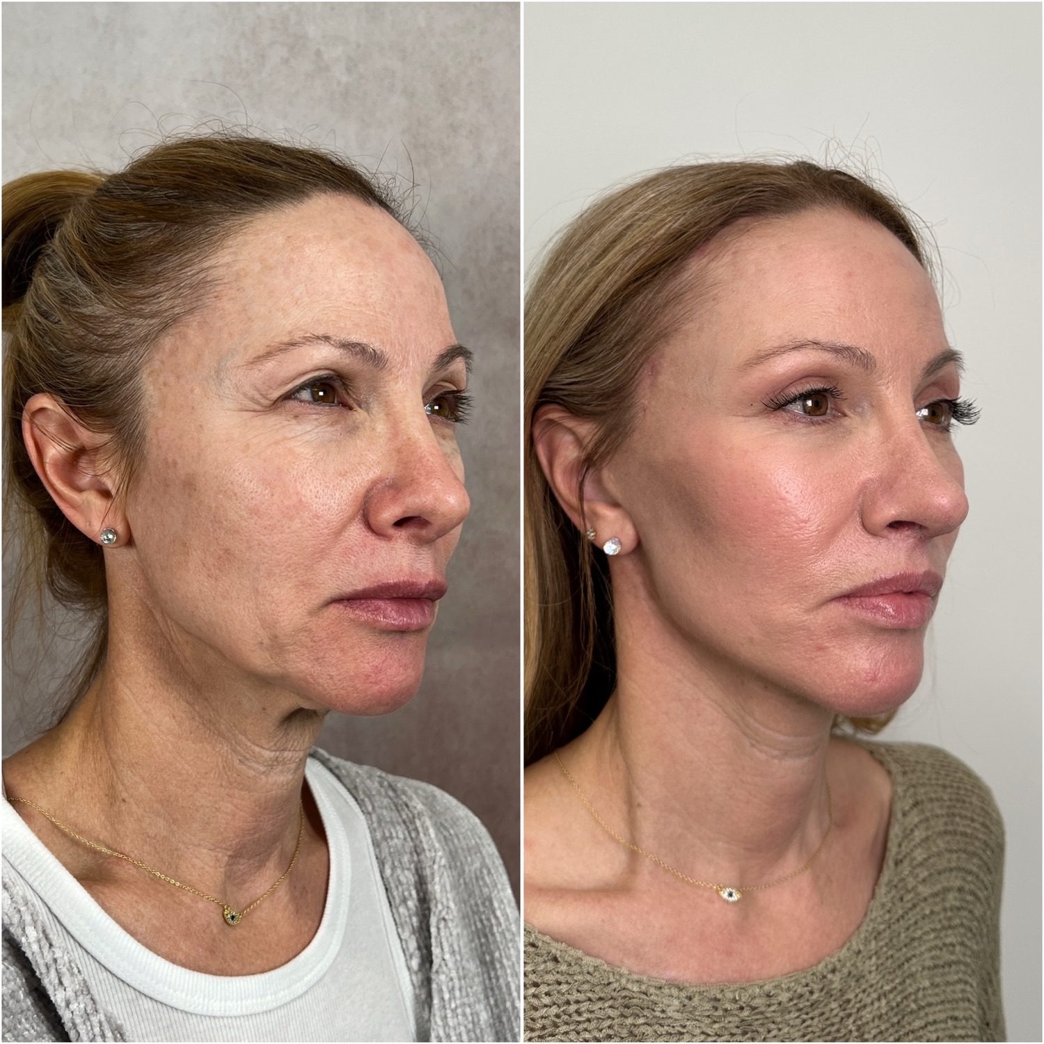 Before and after &mdash; facelift and neck lift as part of The Masterpiece Surgery&trade; with brow lift, upper blepharoplasty, lower lid skin pinch, lip lift, fat transfer, CO2 laser resurfacing and revision rhinoplasty, oblique view