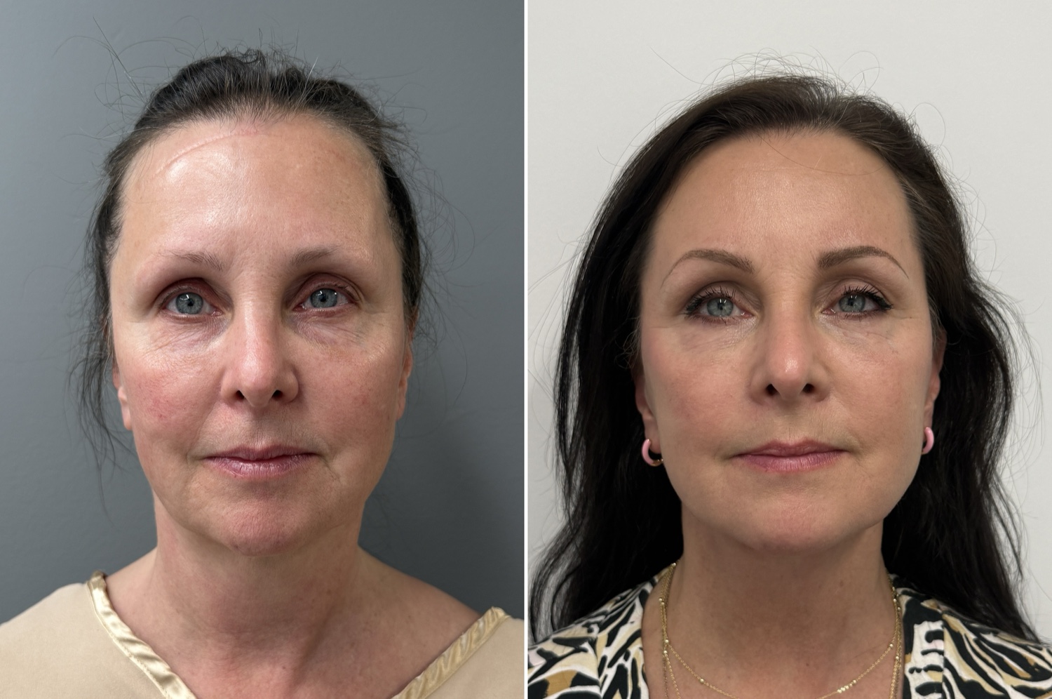 Face & Neck Lift + Blepharoplasty + Fat Transfer before and after · before and after composite