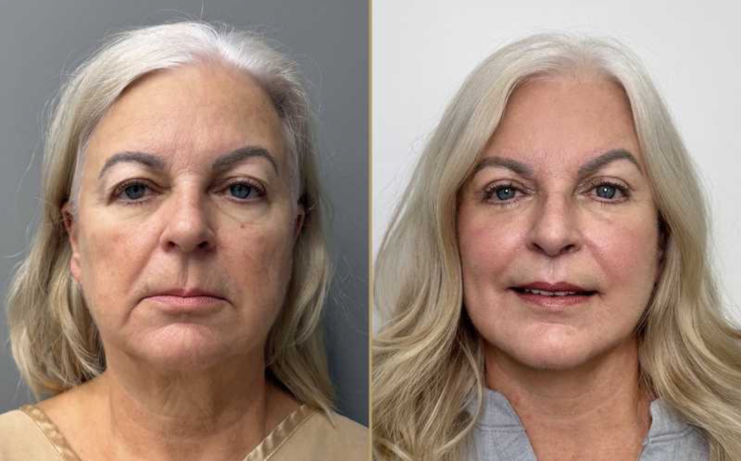 Lip lift as part of The Masterpiece Surgery&trade; before and after · frontal view