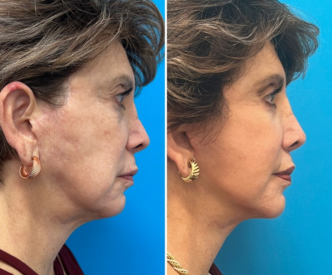 Before and after &mdash; lip lift with facelift and lower bleph, profile view