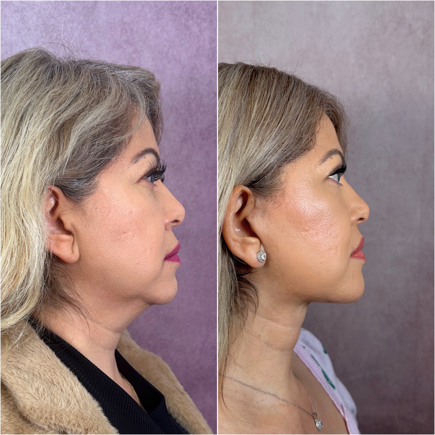 Before and after &mdash; lip lift as part of The Masterpiece, frontal view