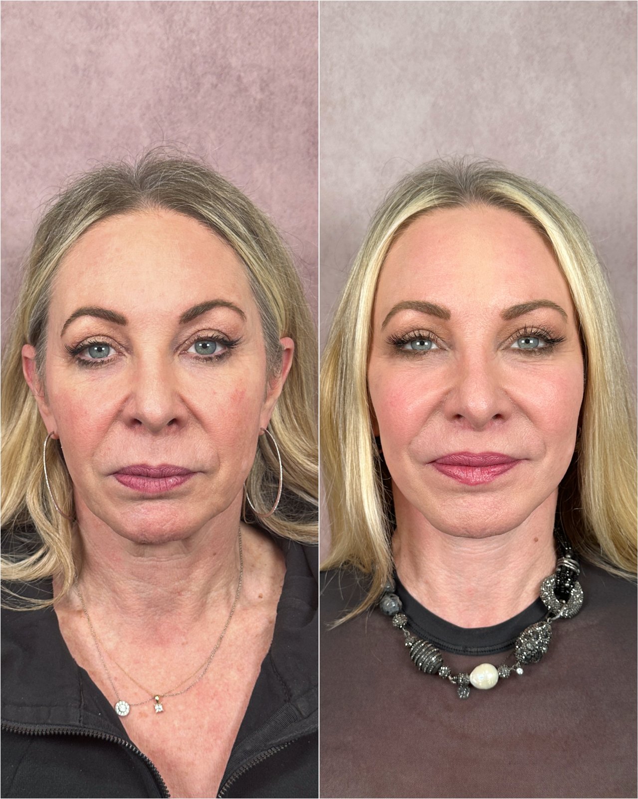 The Masterpiece Surgery&trade; patient &mdash; deep plane facelift, neck lift, and blepharoplasty before and after · before and after composite
