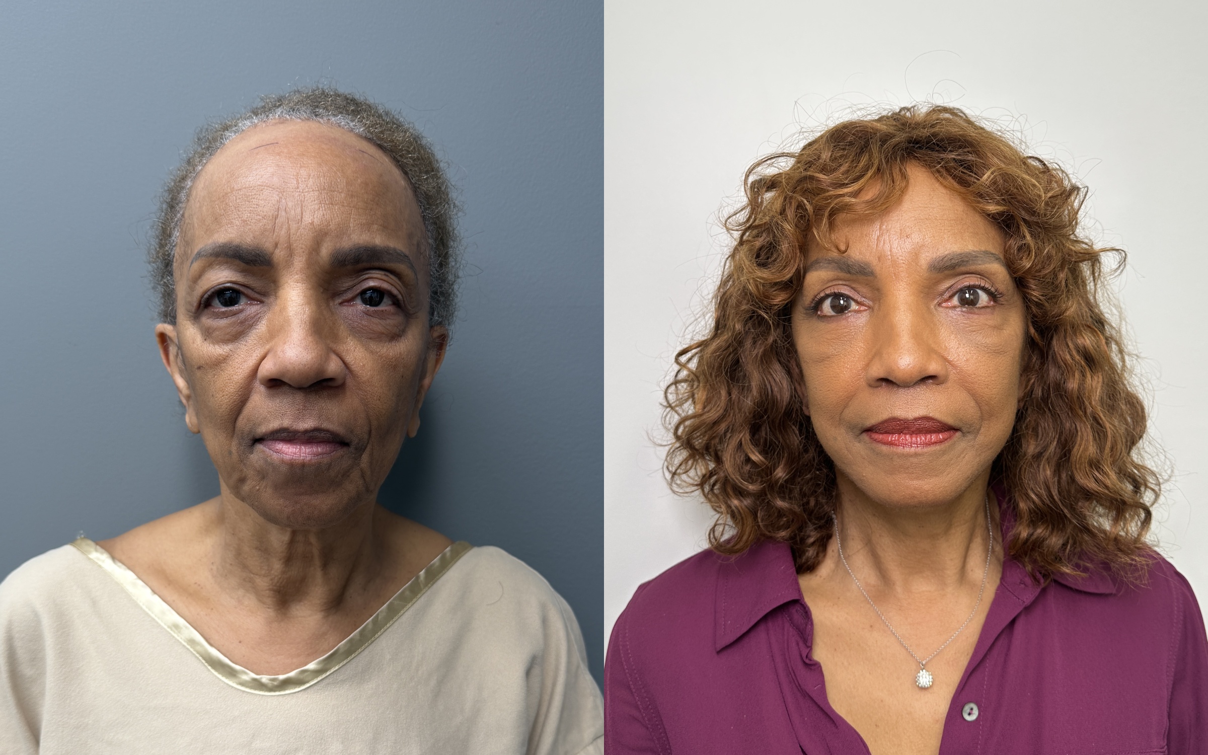 Before and after — The Masterpiece Surgery&trade;, frontal view