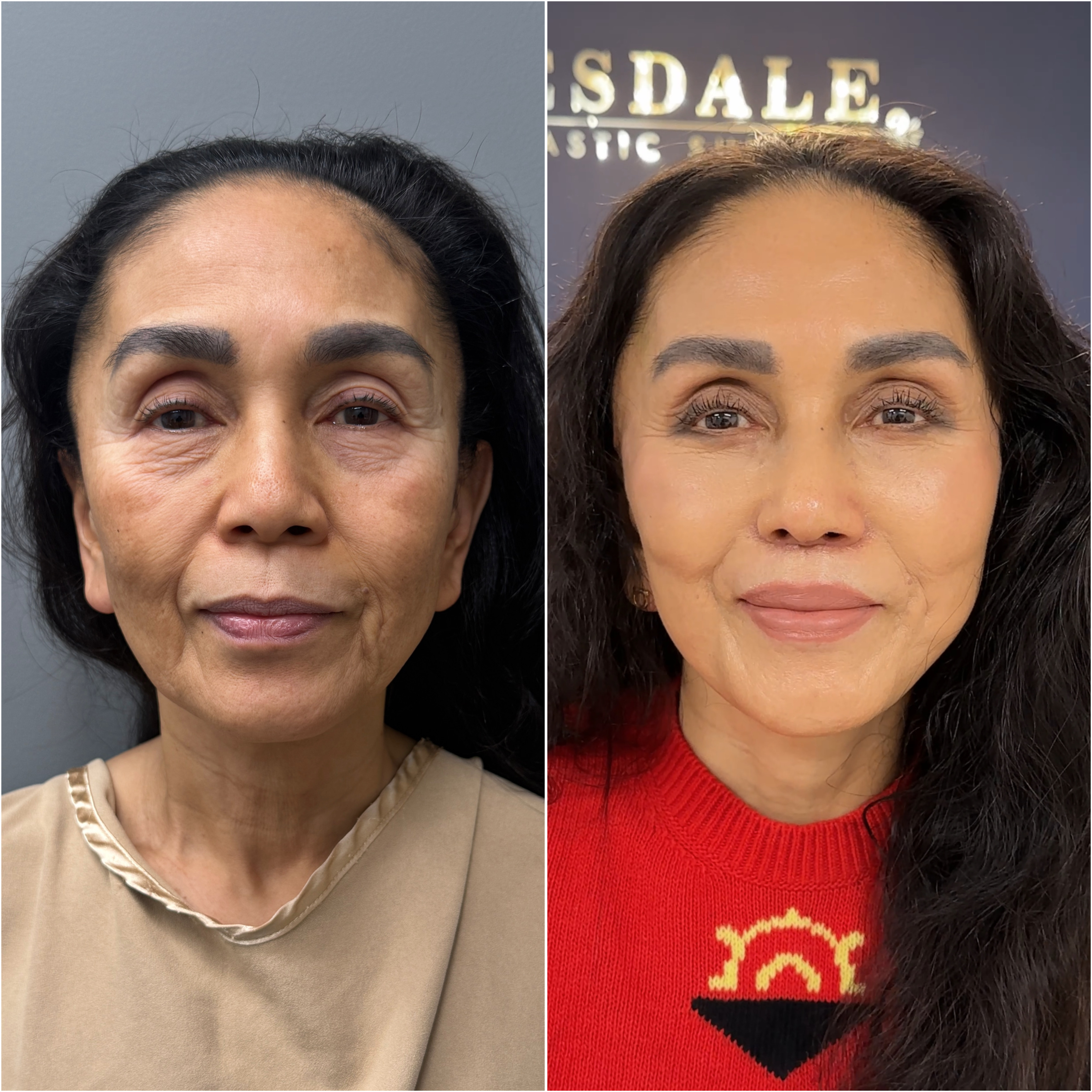 The Masterpiece Surgery&trade; patient &mdash; before and after · before and after composite
