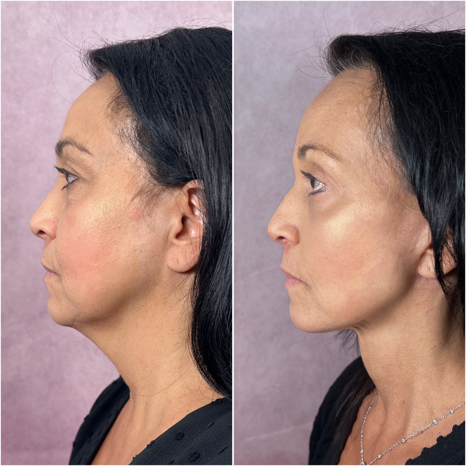 Before and after &mdash; The Masterpiece Surgery&trade;, profile view