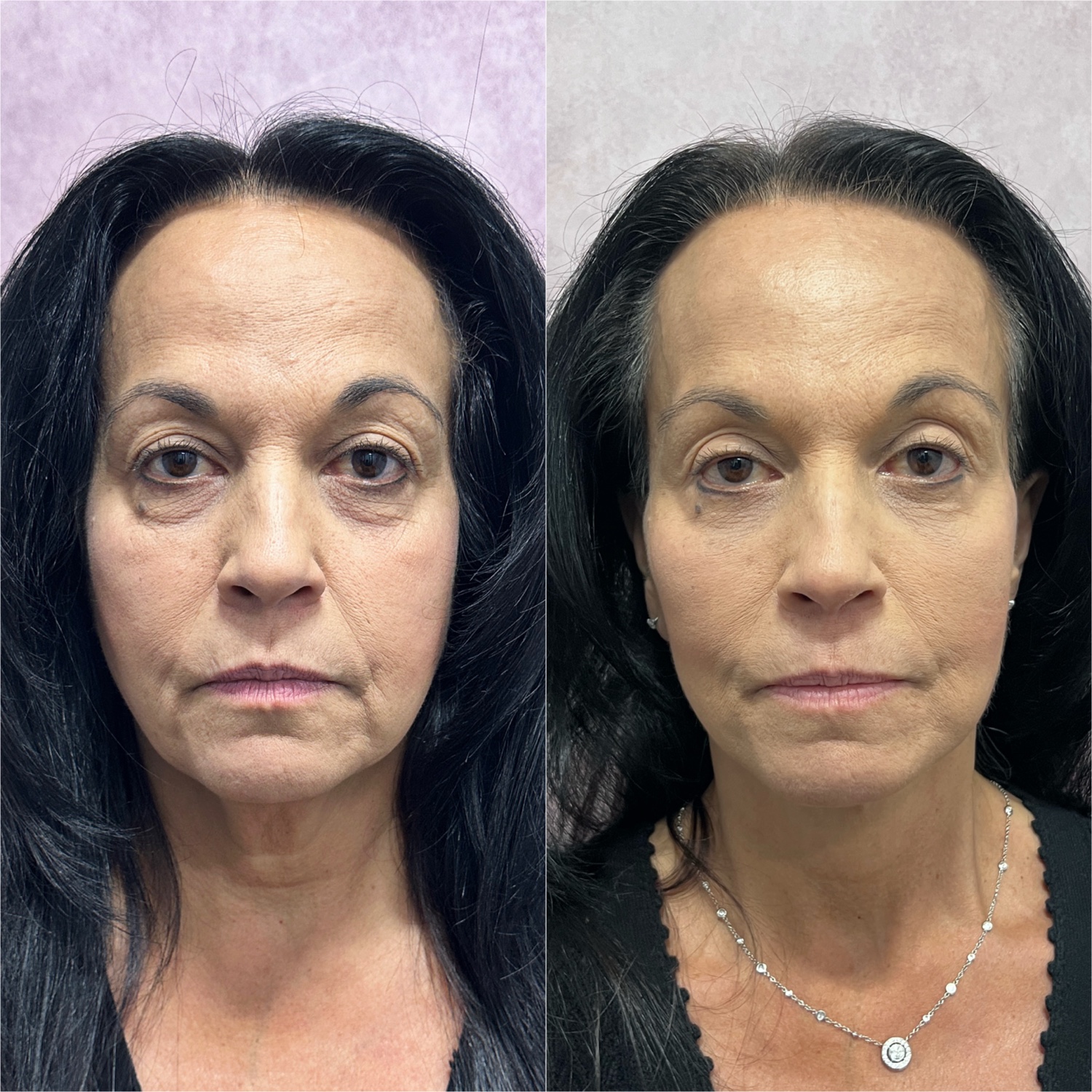 Before and after &mdash; The Masterpiece Surgery&trade;, frontal view