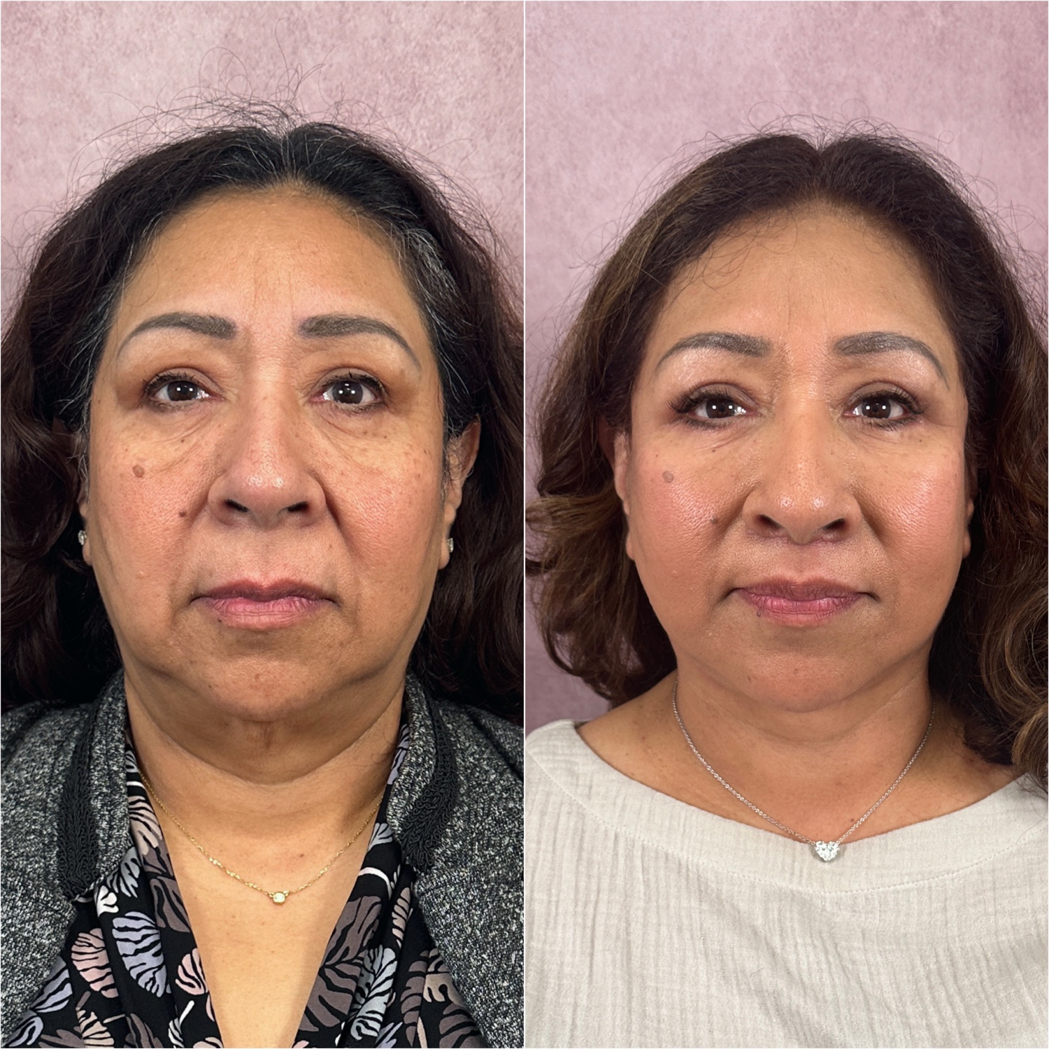 Before and after &mdash; The Masterpiece Surgery&trade;, frontal view
