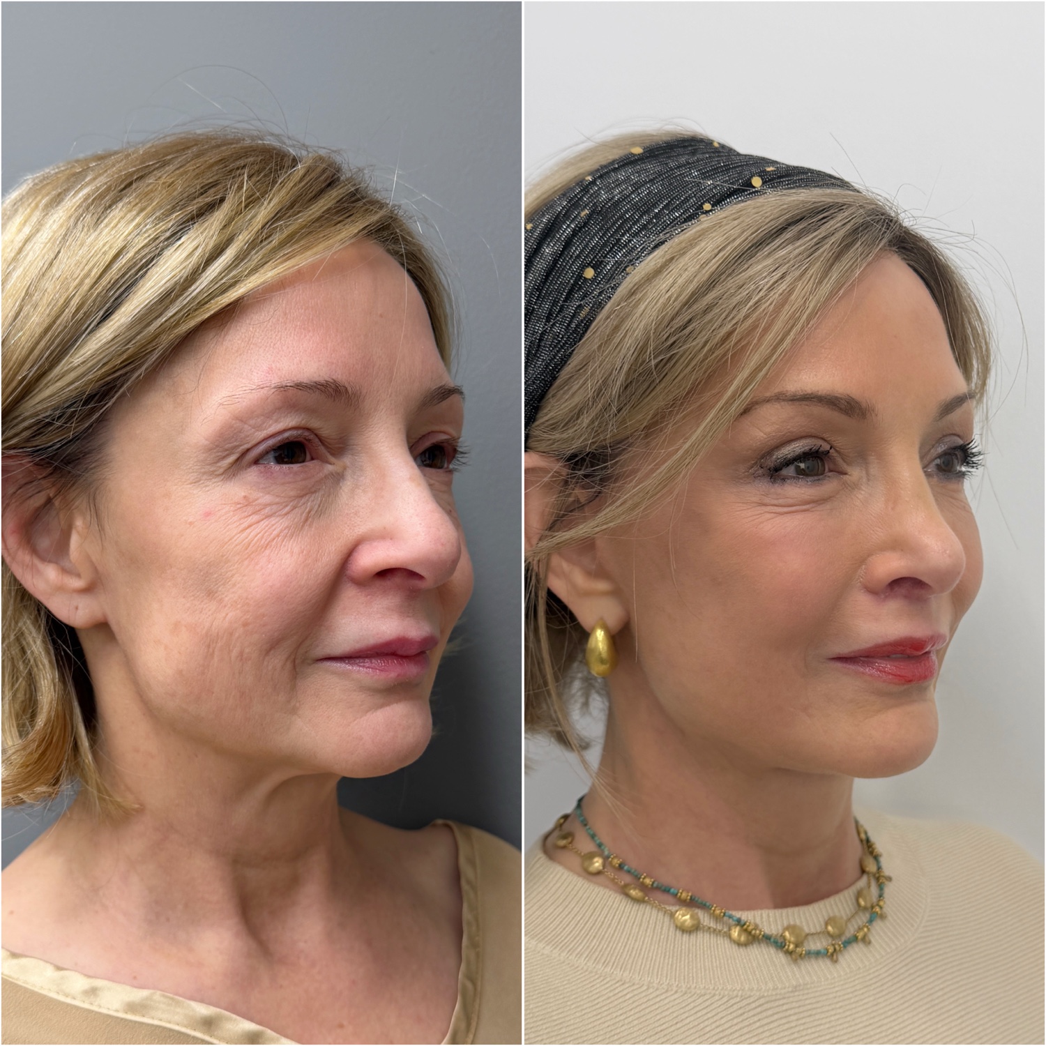Before and after &mdash; The Masterpiece Surgery&trade;, oblique view