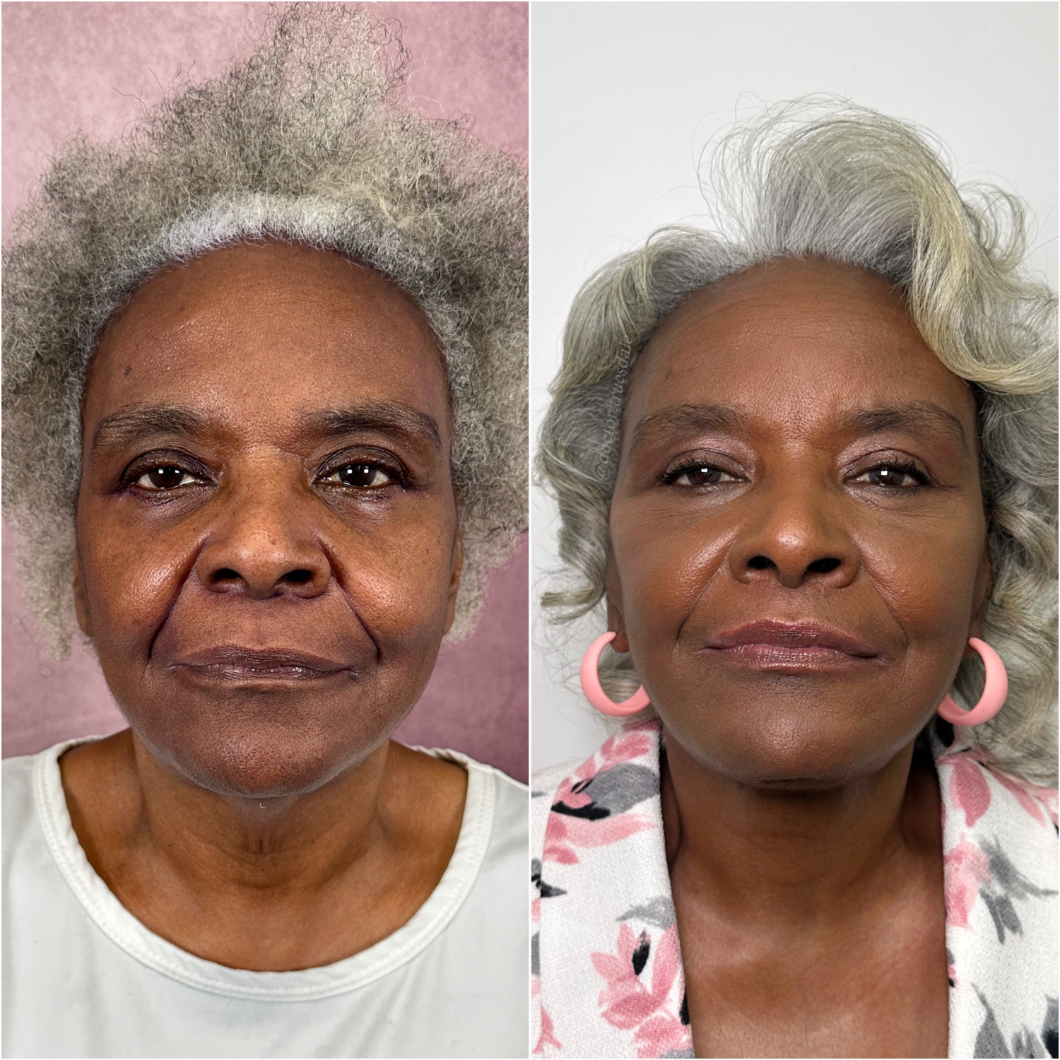 Before and after &mdash; The Masterpiece Surgery&trade;, frontal view