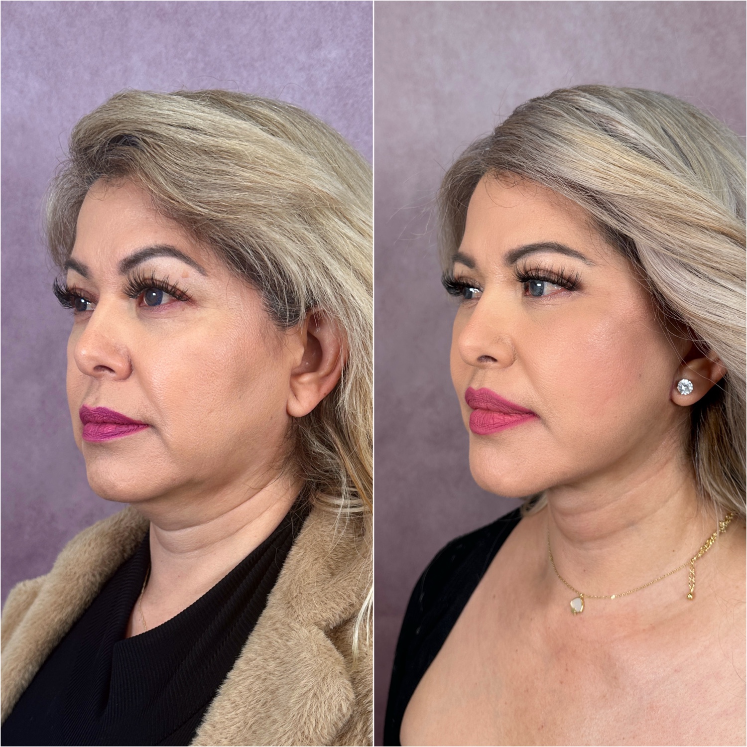 Before and after &mdash; The Masterpiece Surgery&trade;, oblique view