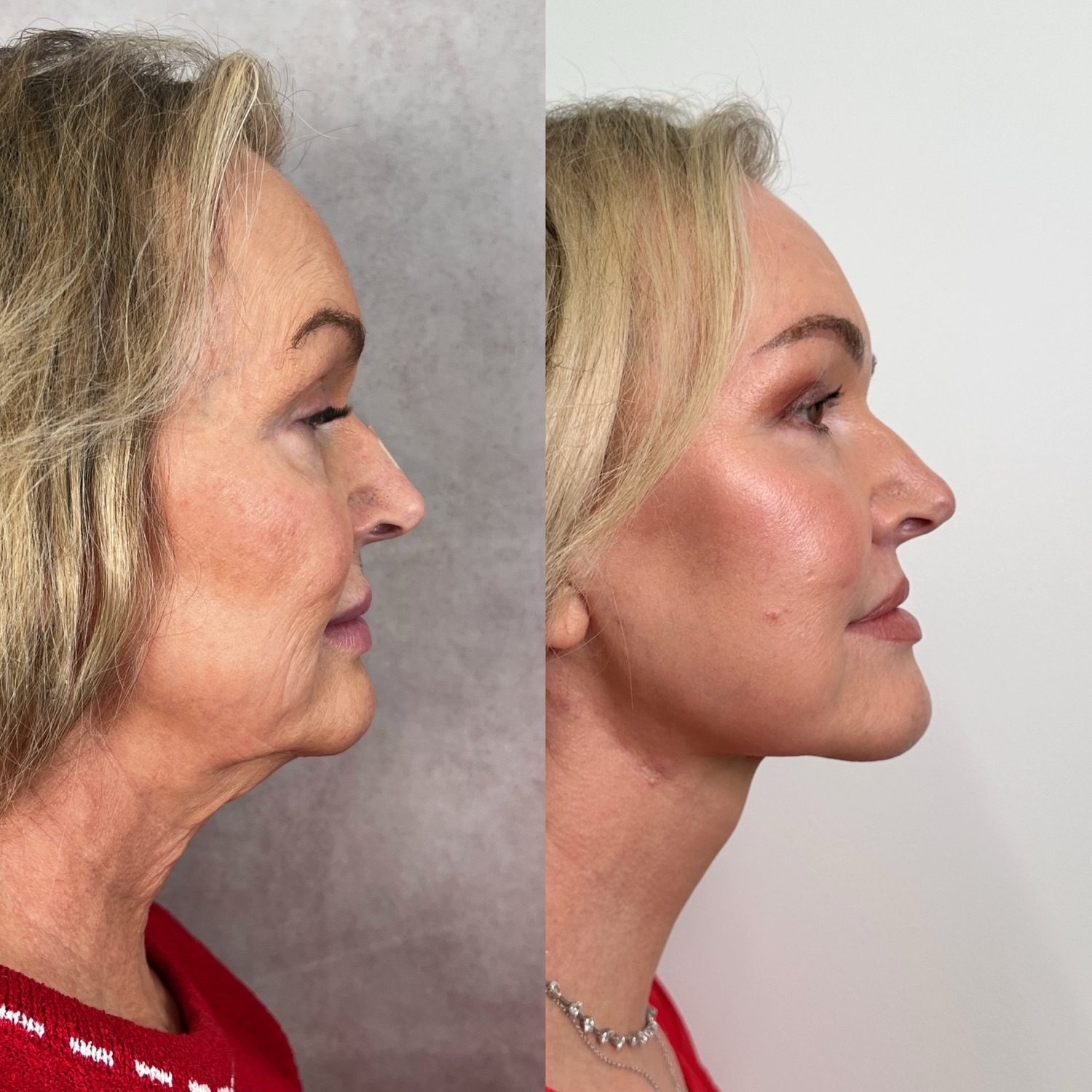 Before and after &mdash; The Masterpiece Surgery&trade;: deep plane facelift, deep neck lift, brow lift, upper blepharoplasty, lower lid skin pinch, lip lift, fat transfer and CO2 laser resurfacing, profile view