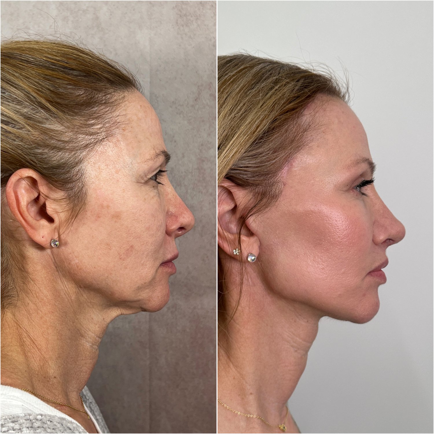 Deep Plane Facelift & Neck Lift before and after · profile view