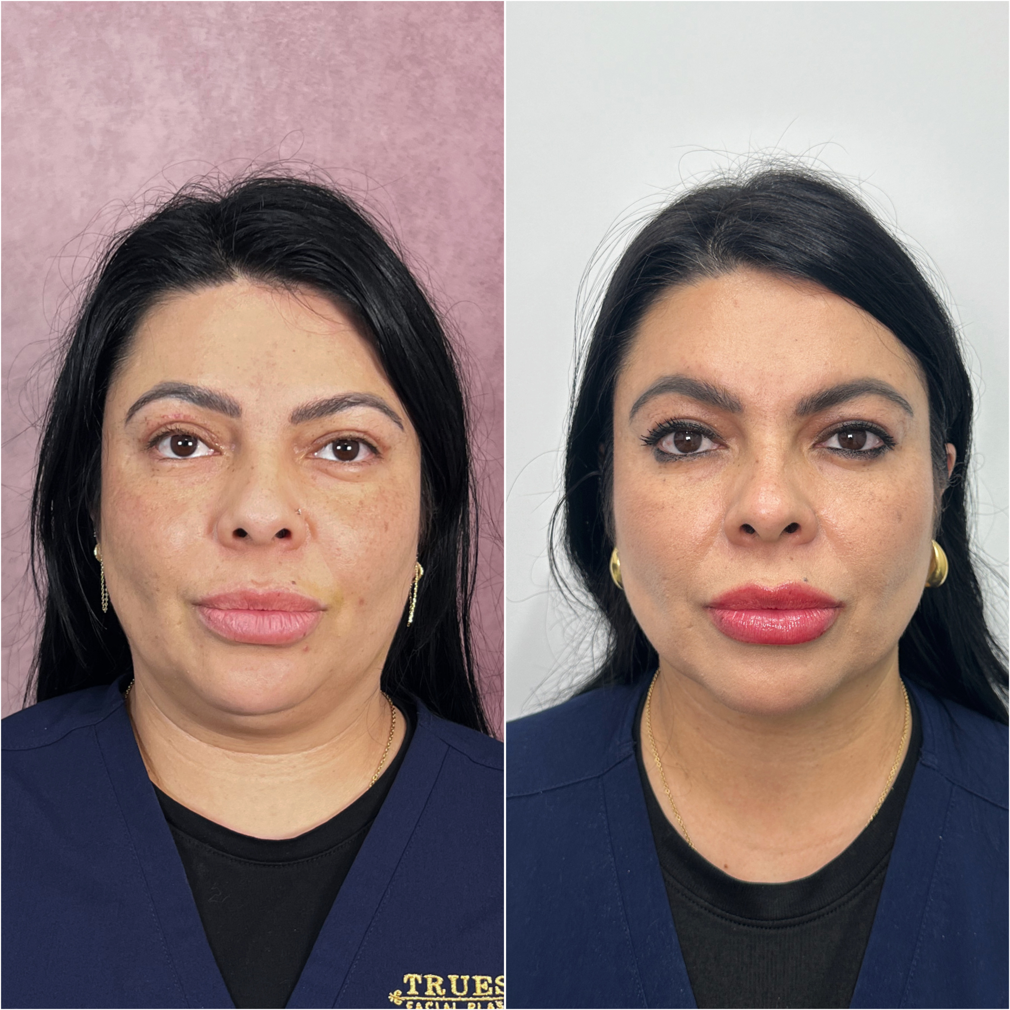 Before and after &mdash; deep neck lift, frontal view