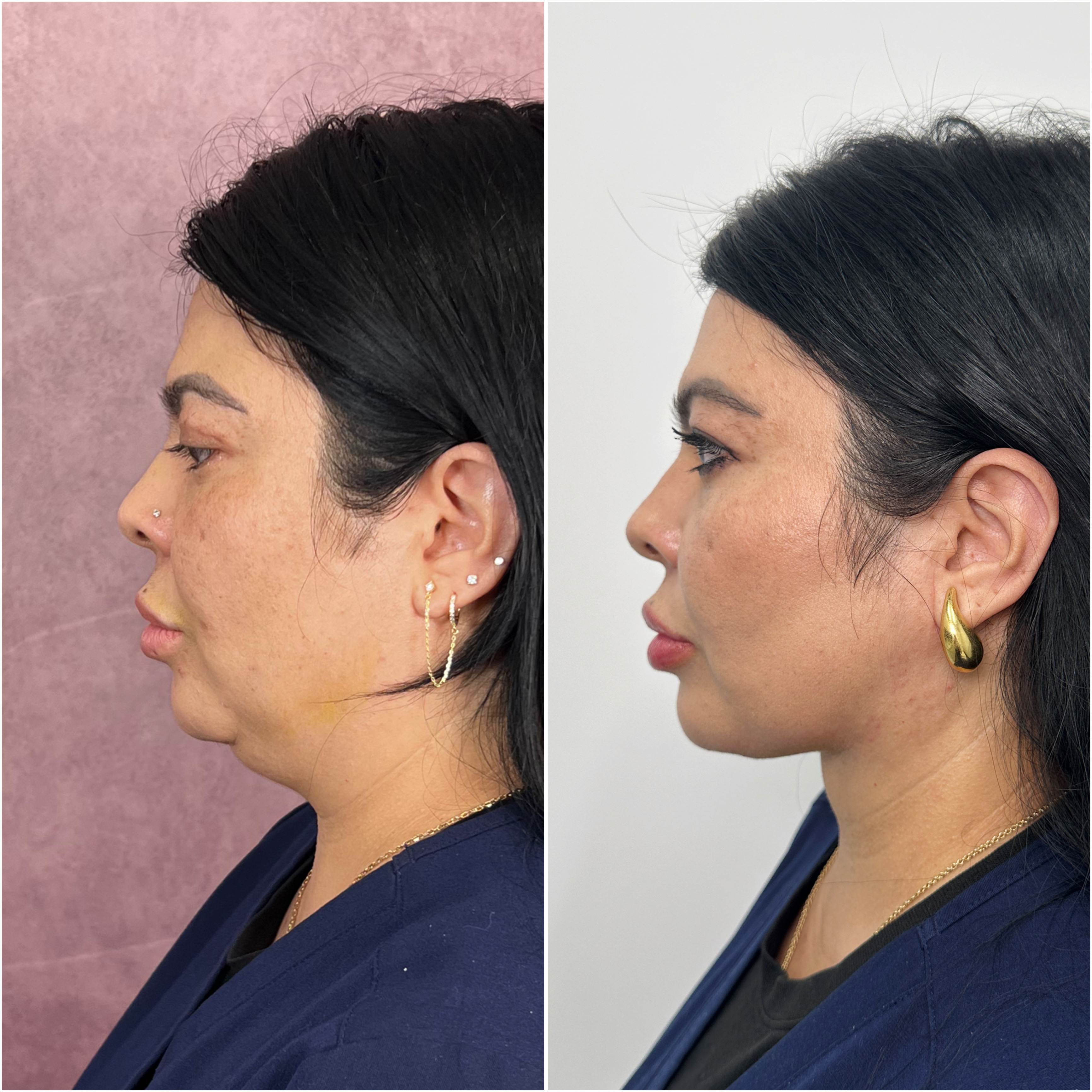 Before and after &mdash; deep neck lift, profile view