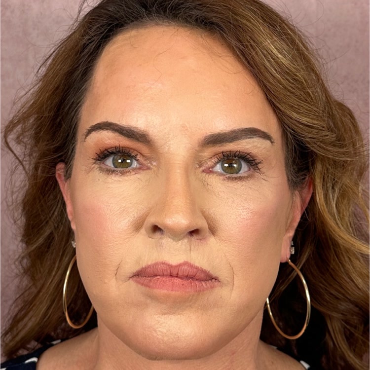 Featured patient before and after - Brow Lift · before and after composite